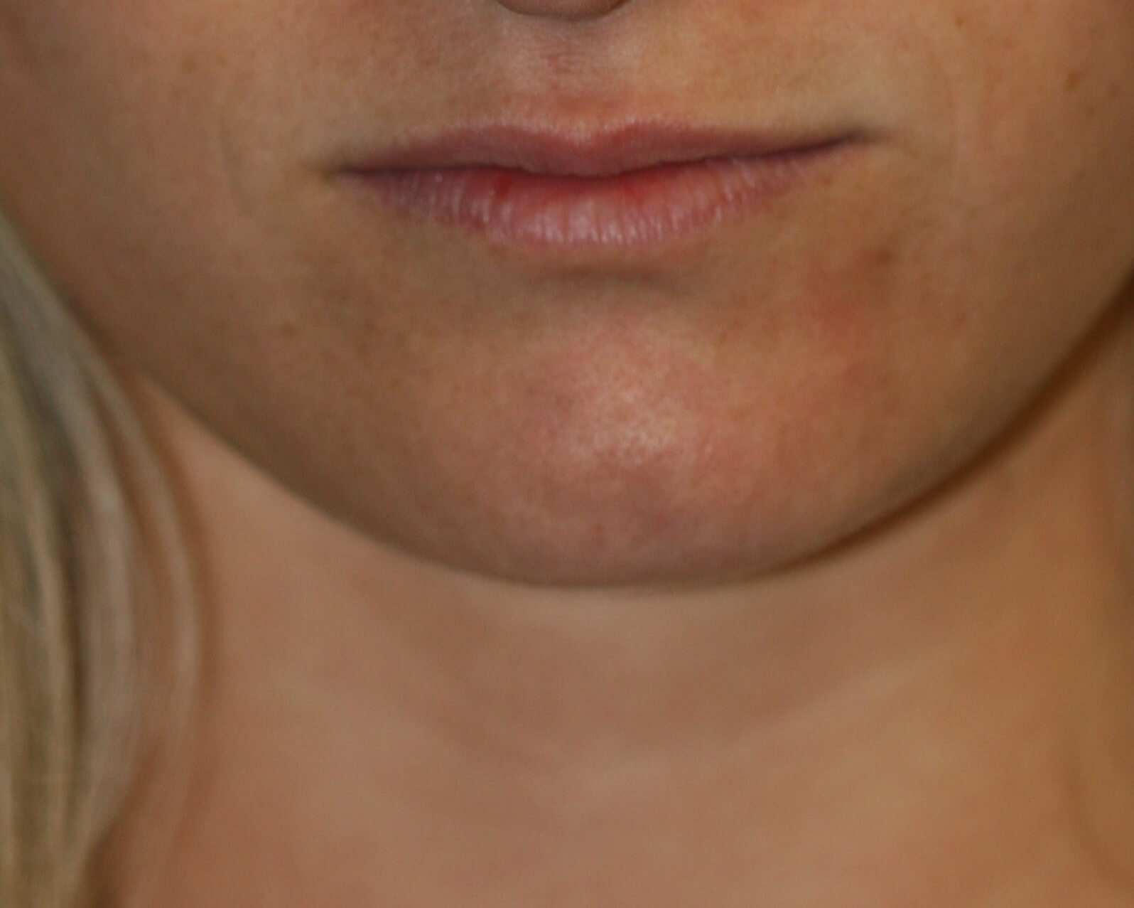 Lip Enhancement - Before & After - Dr. Placik