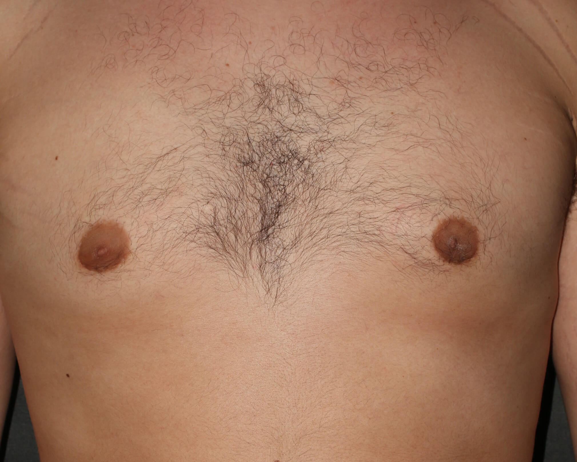 Male Breast Reduction - Before & After - Dr. Placik