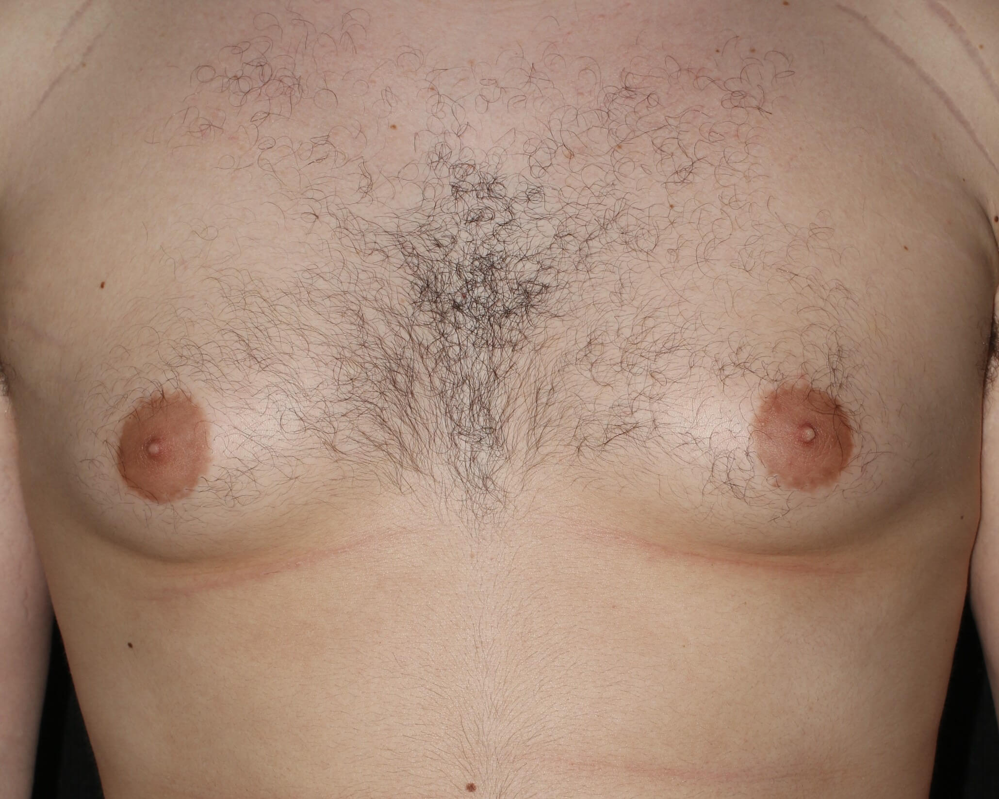 Male Breast Reduction - Before & After - Dr. Placik