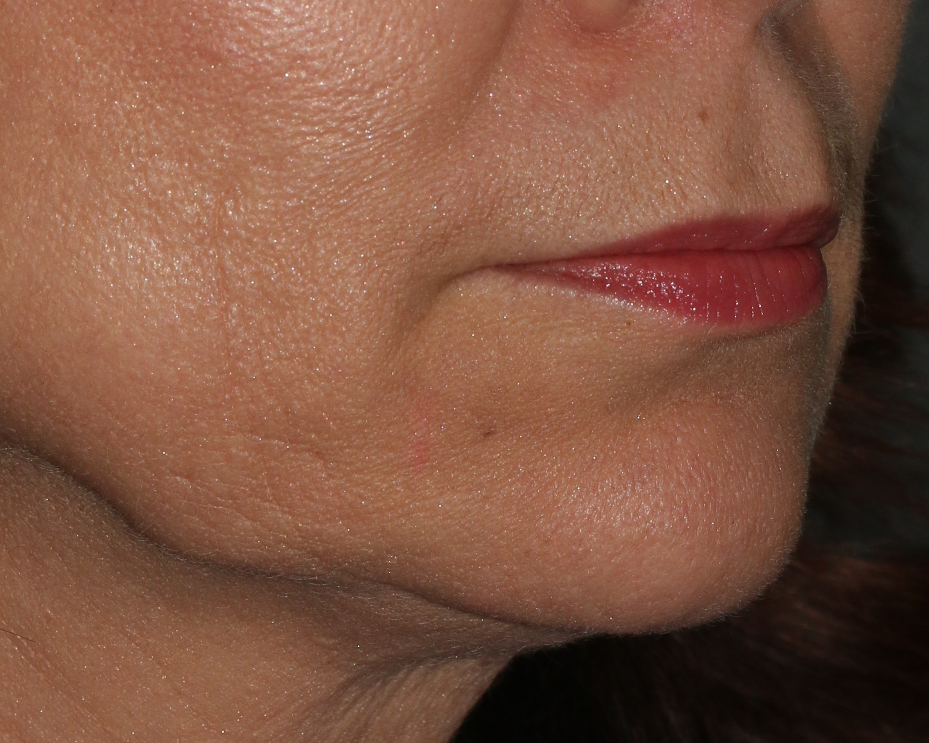 Injectable Filler - Before & After - Dr. Placik