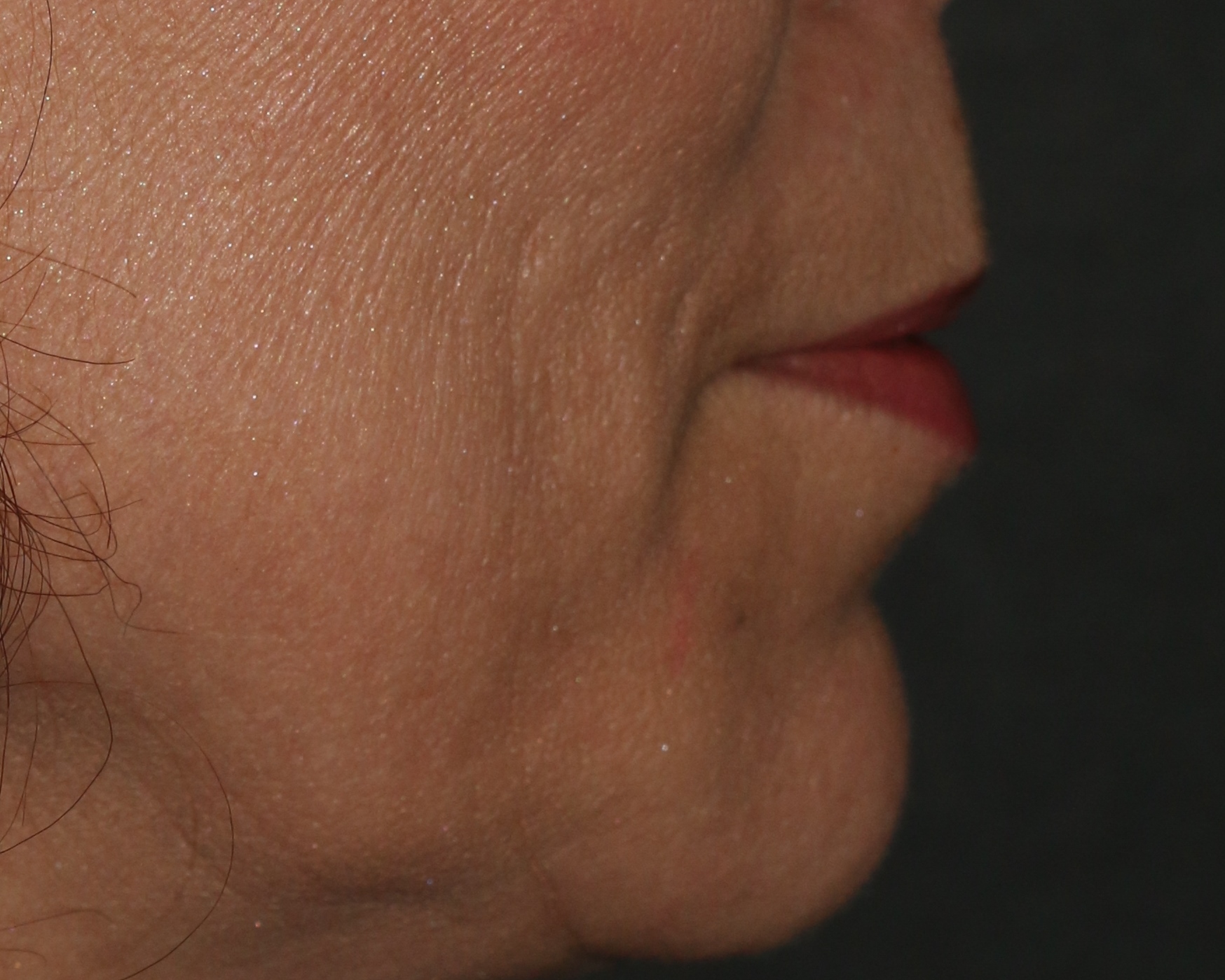 Injectable Filler Chicago