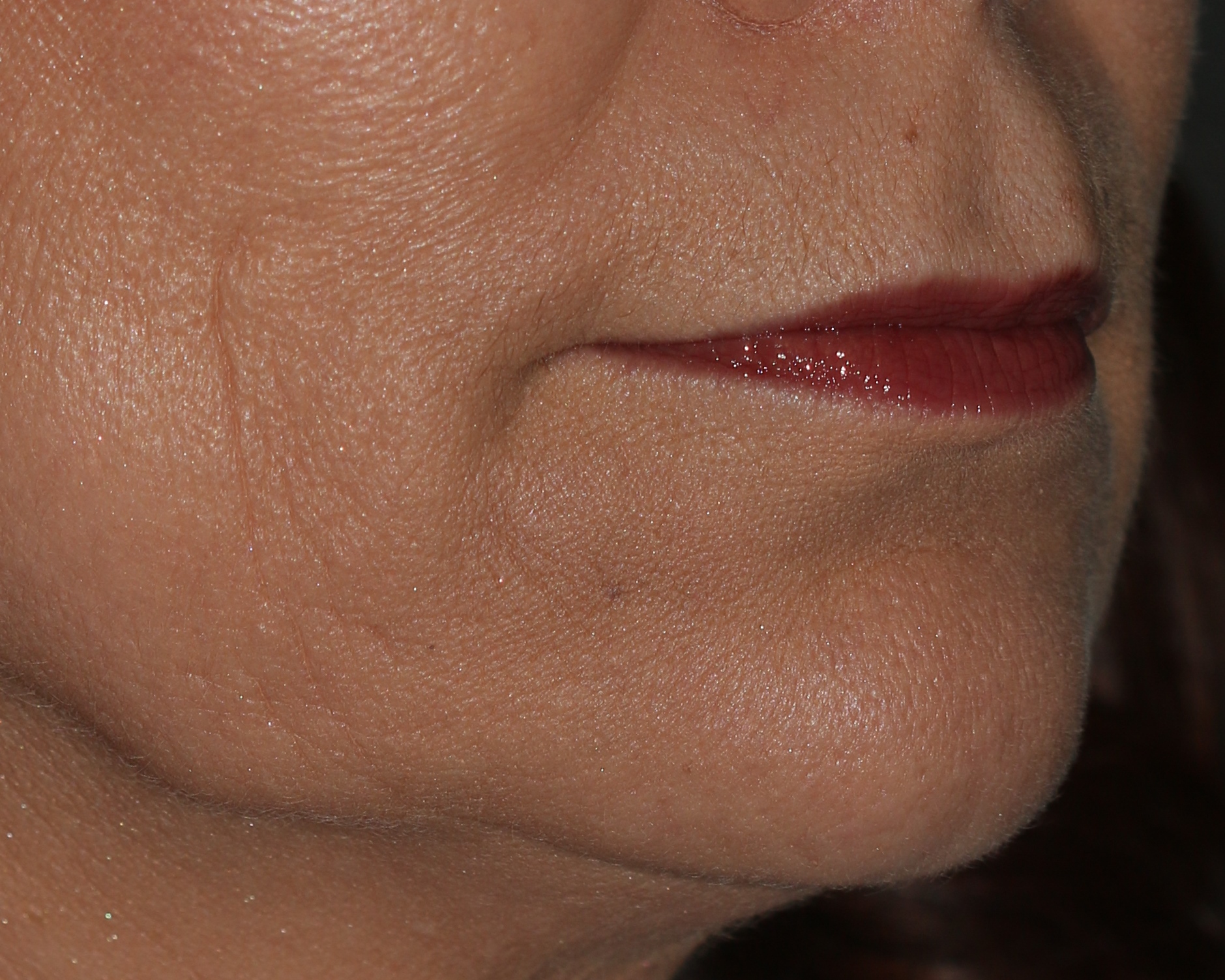 Injectable Filler - Before & After - Dr. Placik