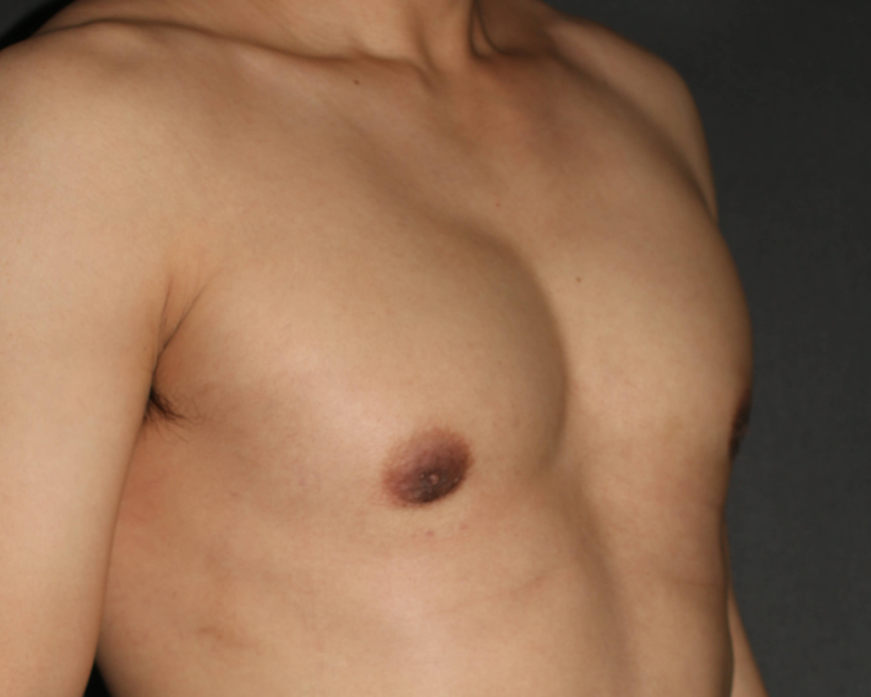 Male Breast Reduction - Before & After - Dr. Placik