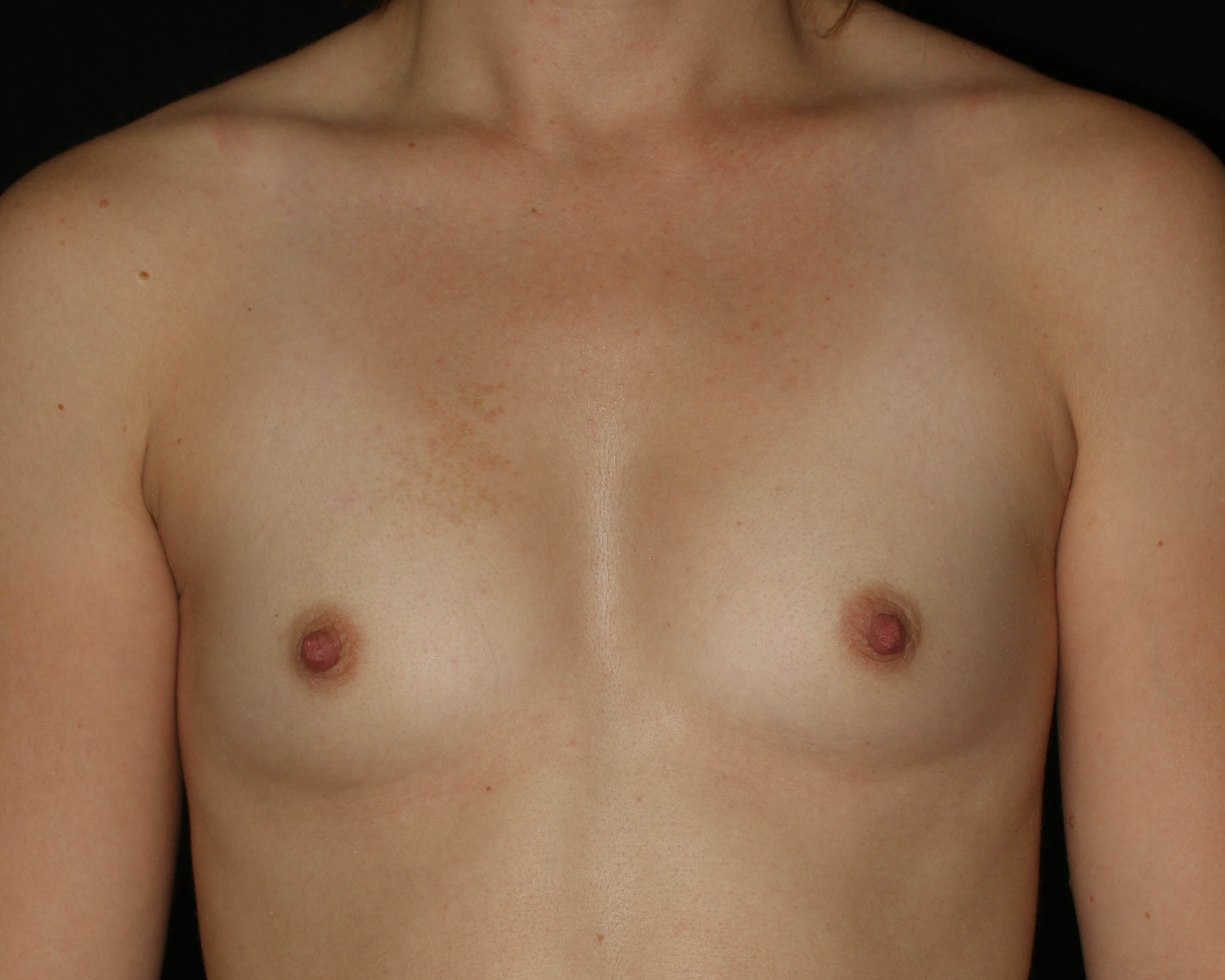 Before & After Breast Augmentation Gallery - Before & After - Dr. Placik