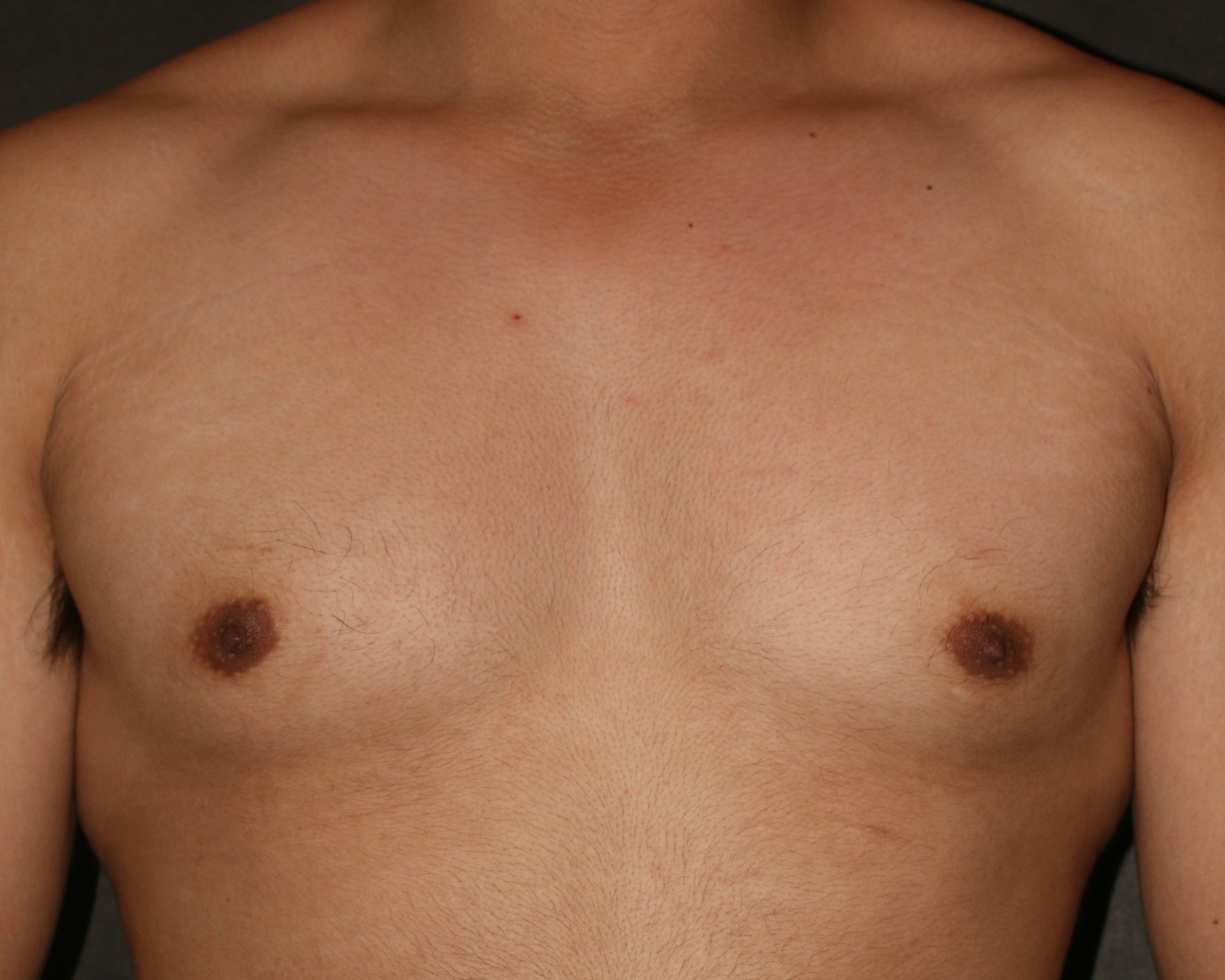 Nipple Reduction - Before & After - Dr. Placik