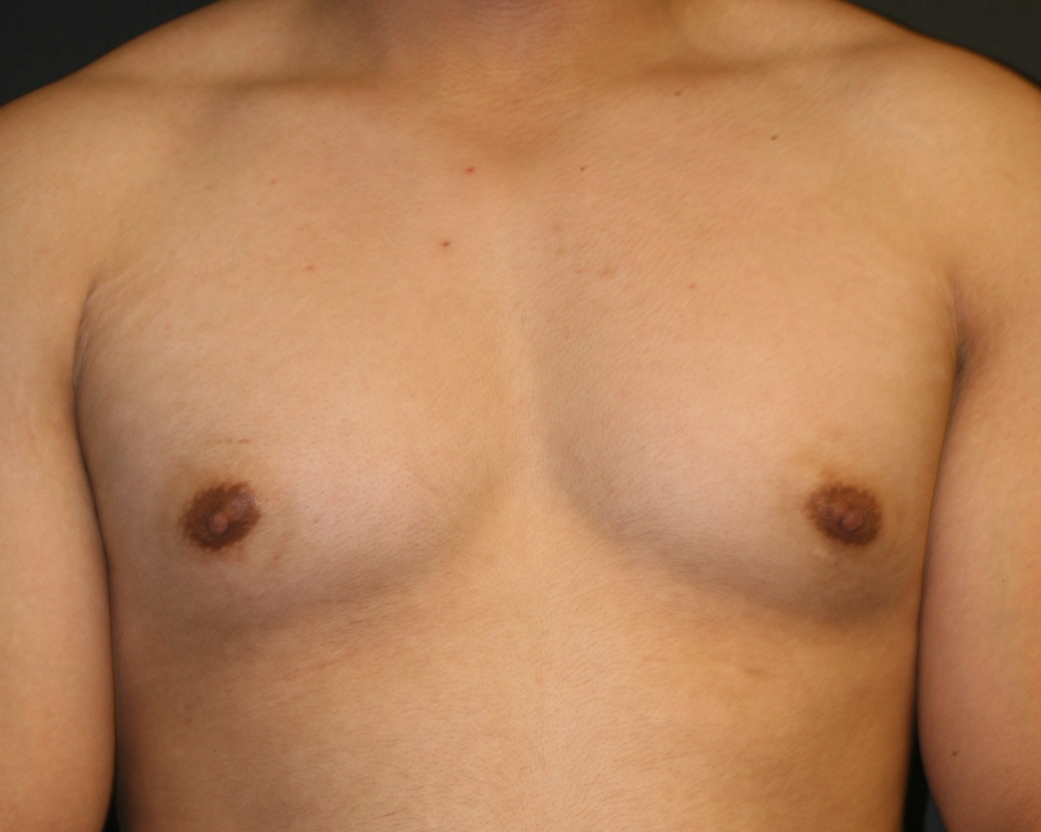 Nipple Reduction - Before & After - Dr. Placik