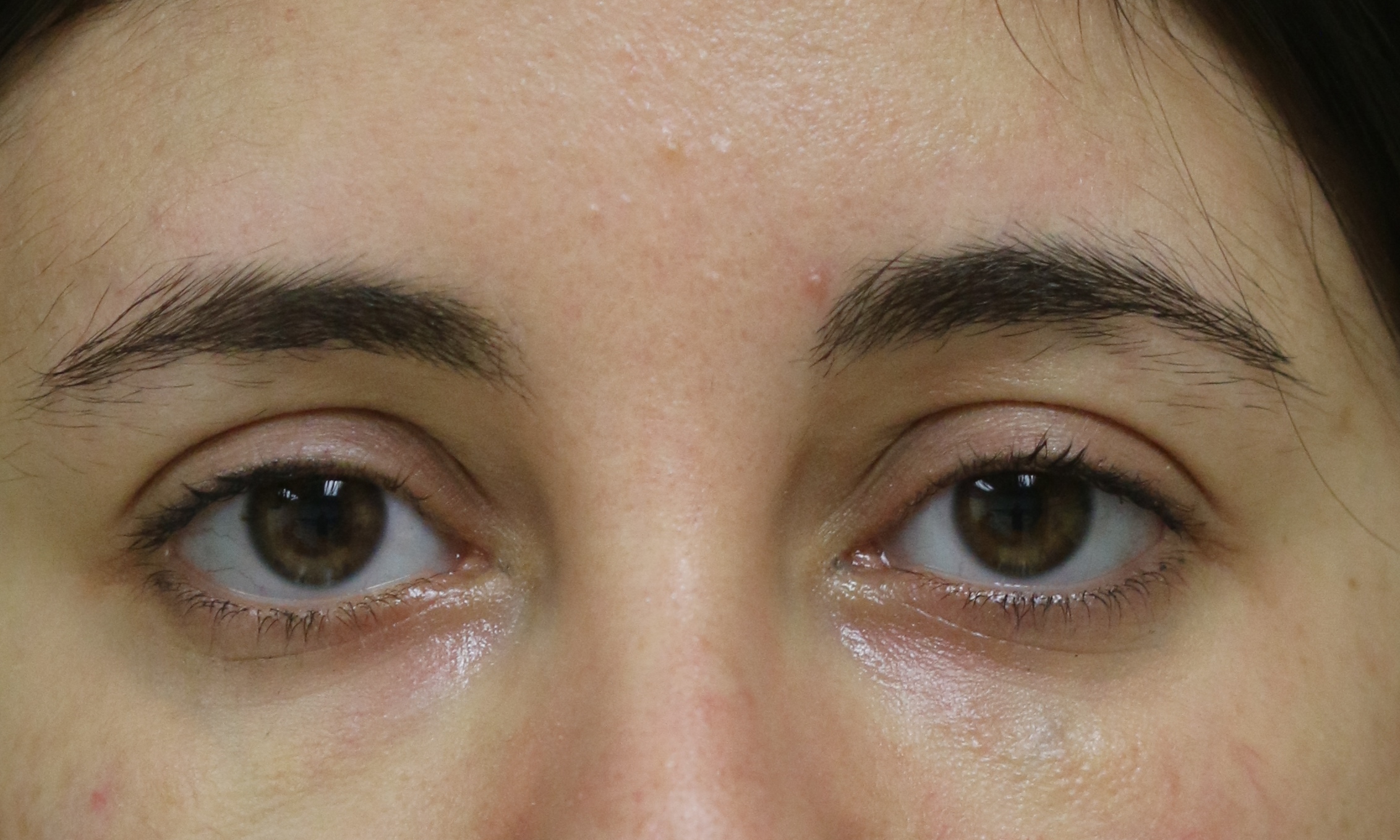 Injectable Filler - Before & After - Dr. Placik