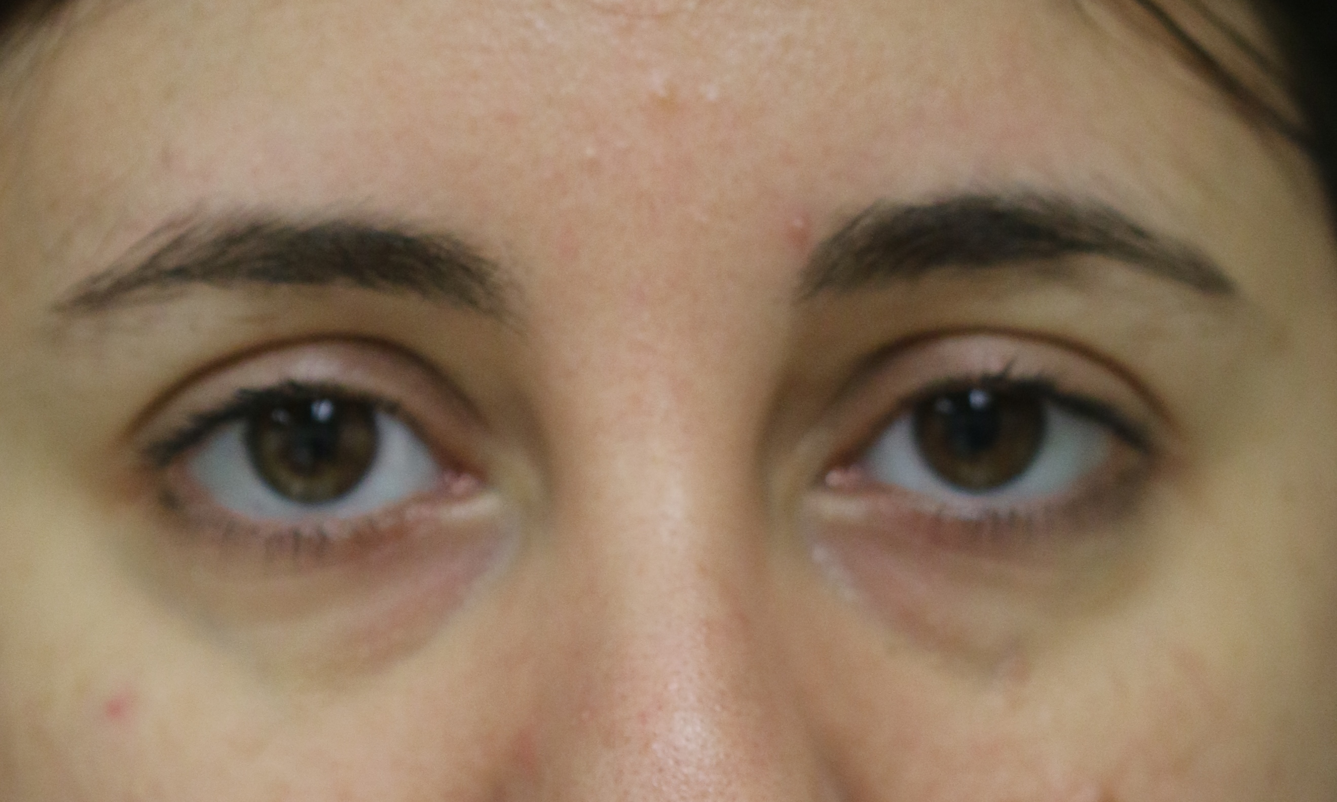 Injectable Filler - Before & After - Dr. Placik