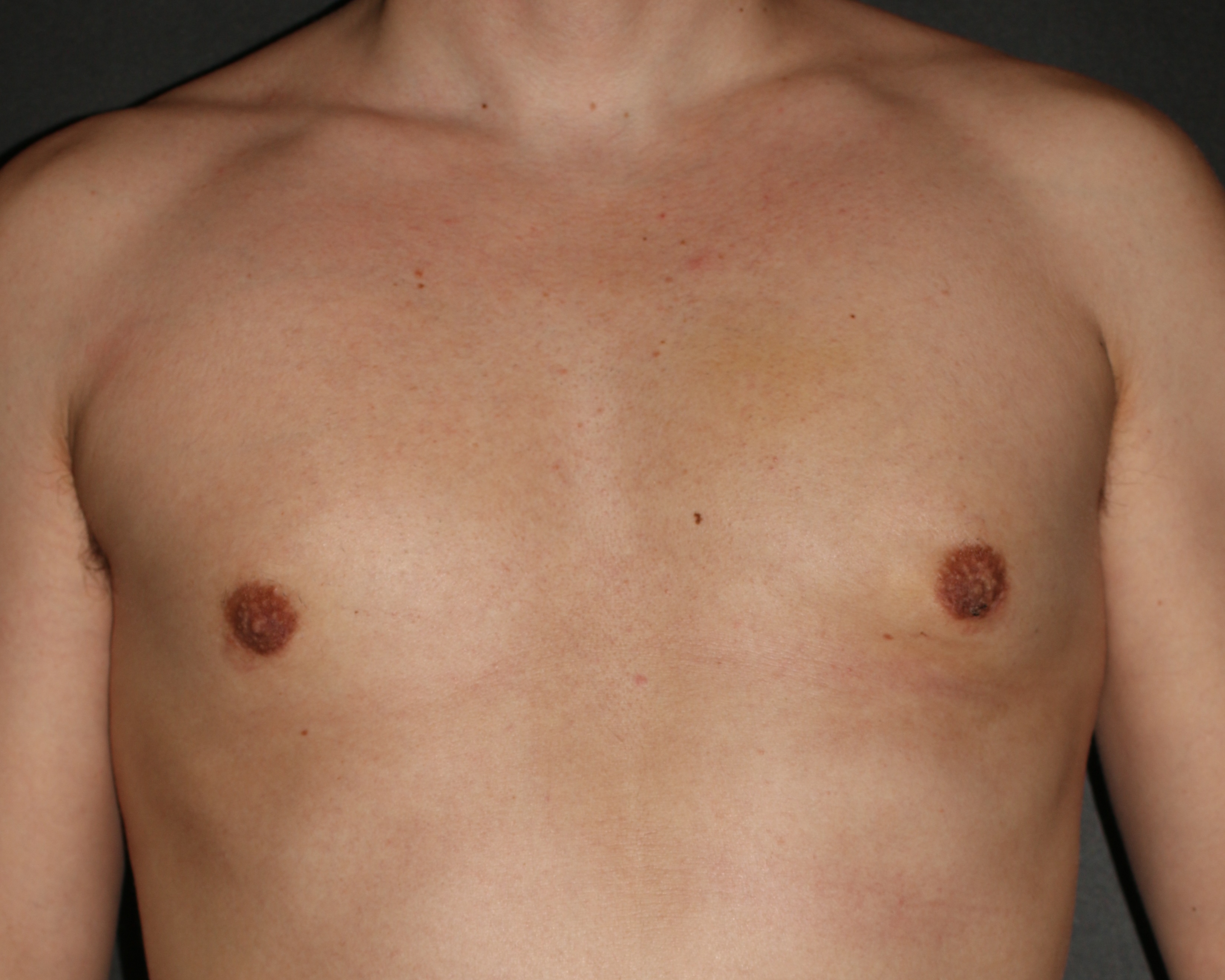 Gynecomastia utilizing excision & liposuction