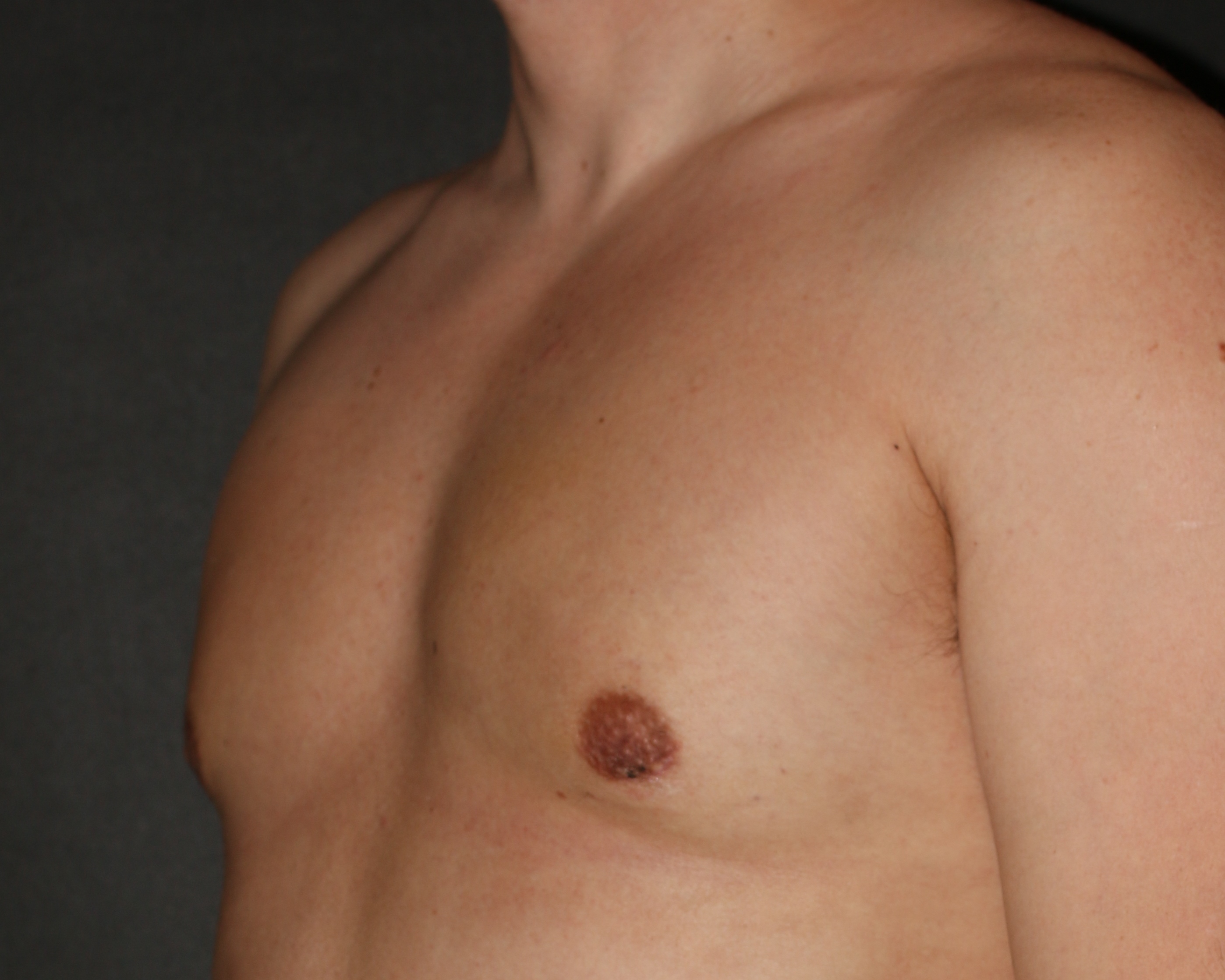 Male Breast Reduction - Before & After - Dr. Placik