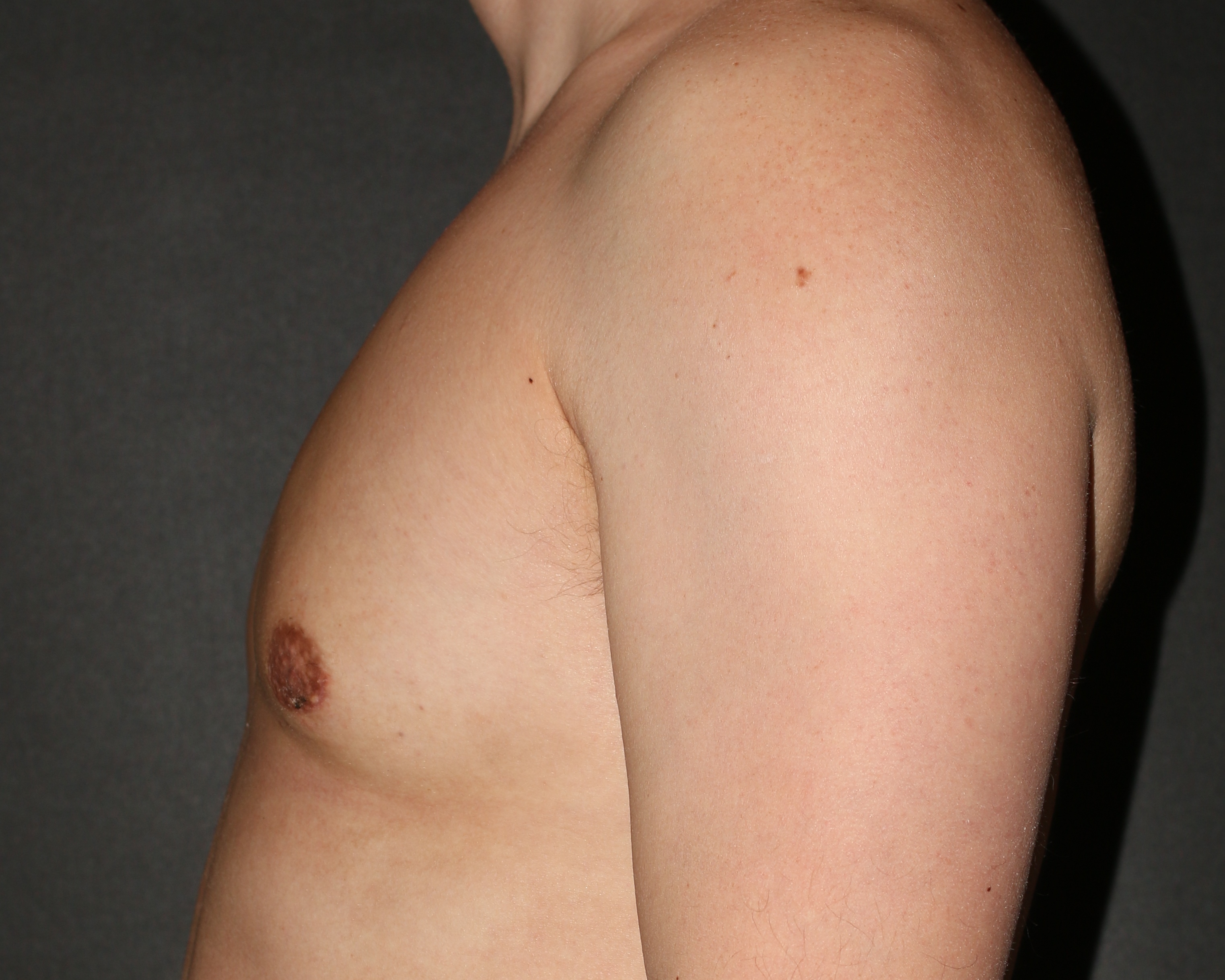 Gynecomastia utilizing excision & liposuction