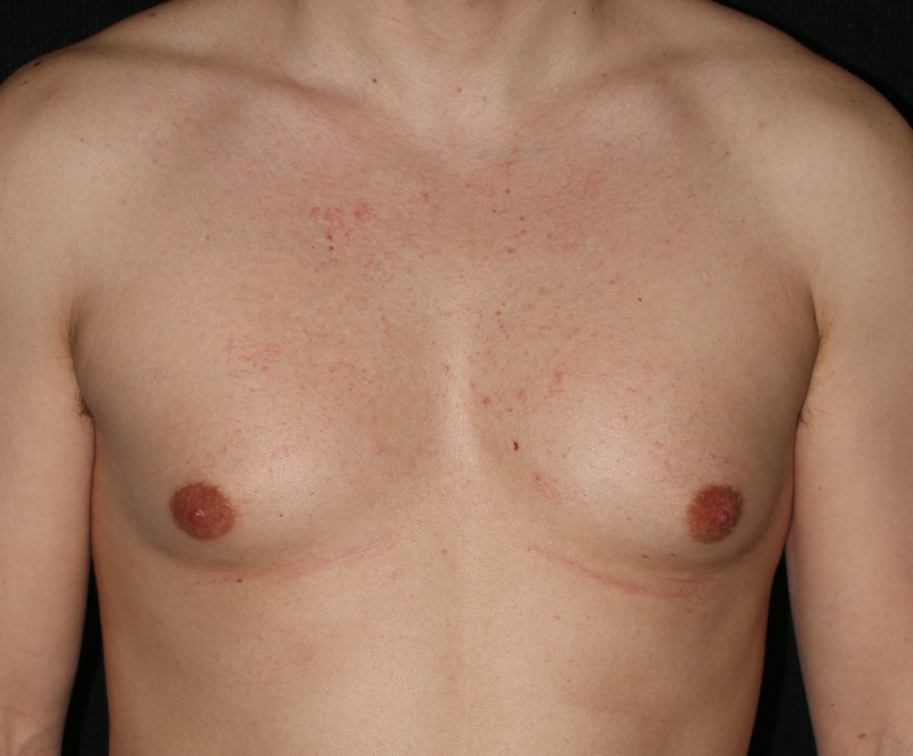 Gynecomastia utilizing excision & liposuction