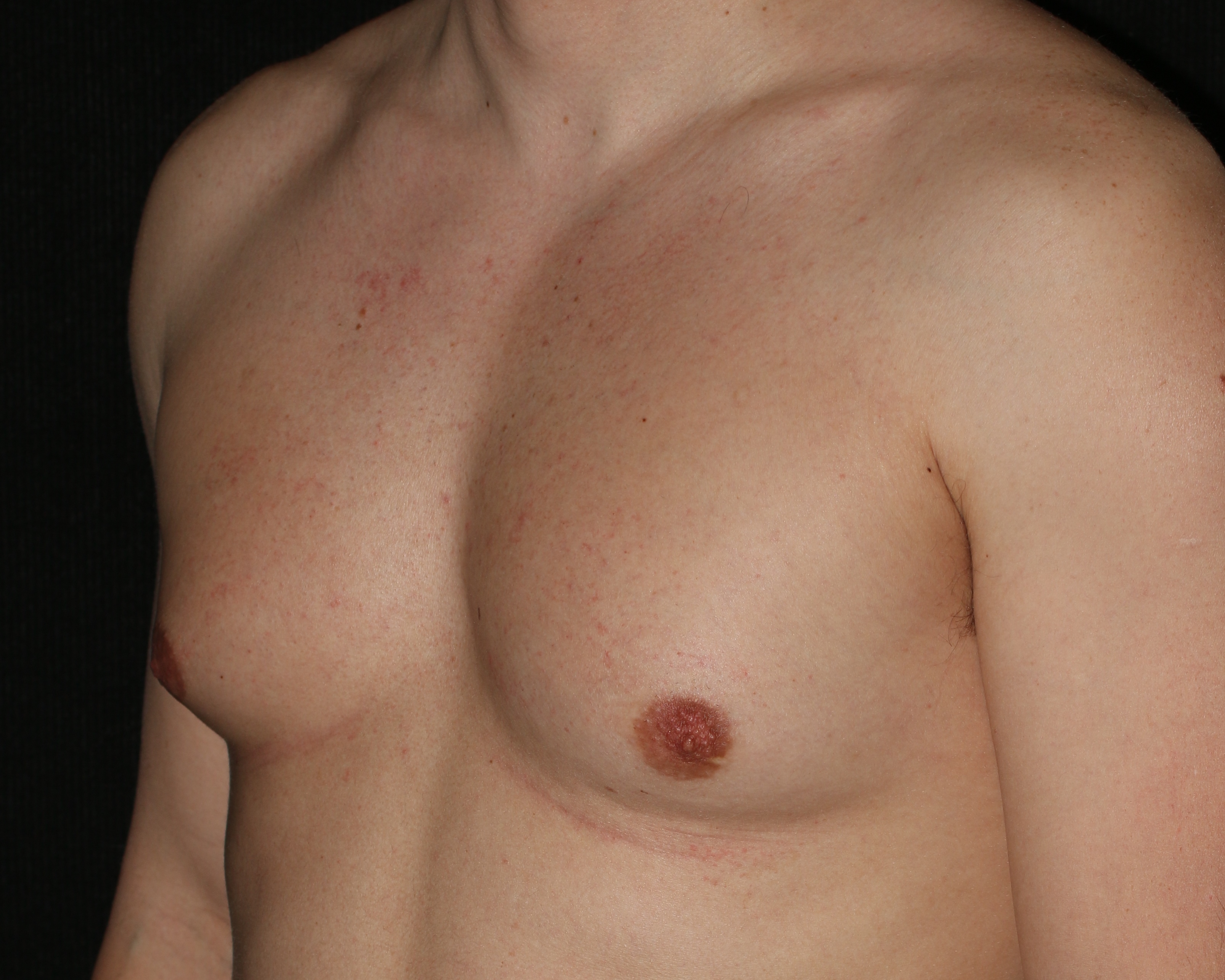 Male Breast Reduction - Before & After - Dr. Placik