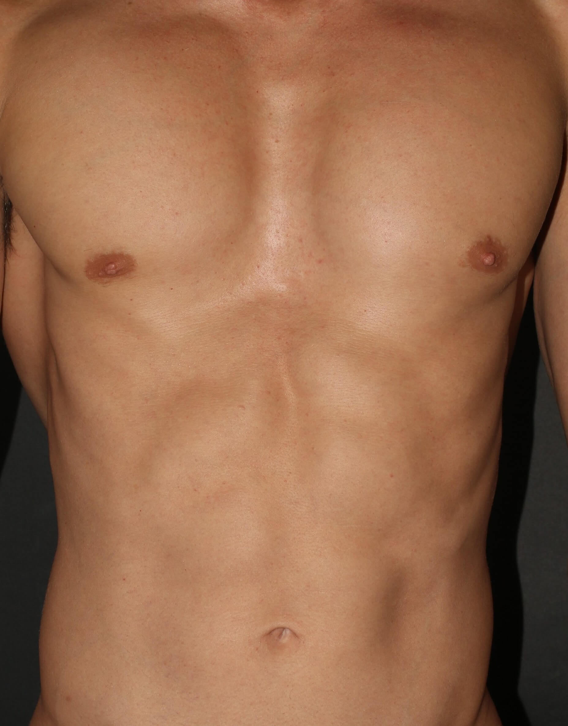 Injectables for Men - Before & After - Dr. Placik