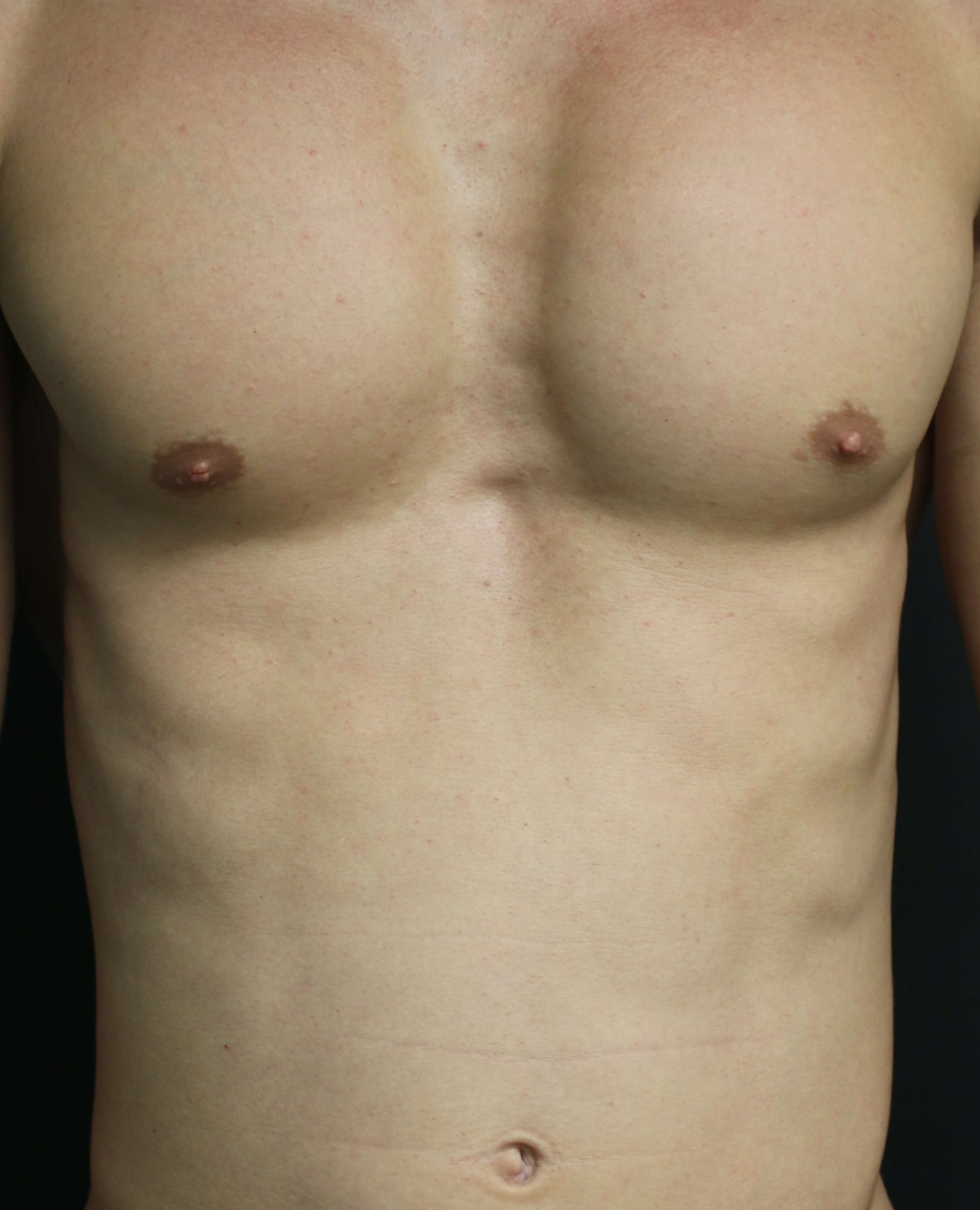 Injectables for Men - Before & After - Dr. Placik