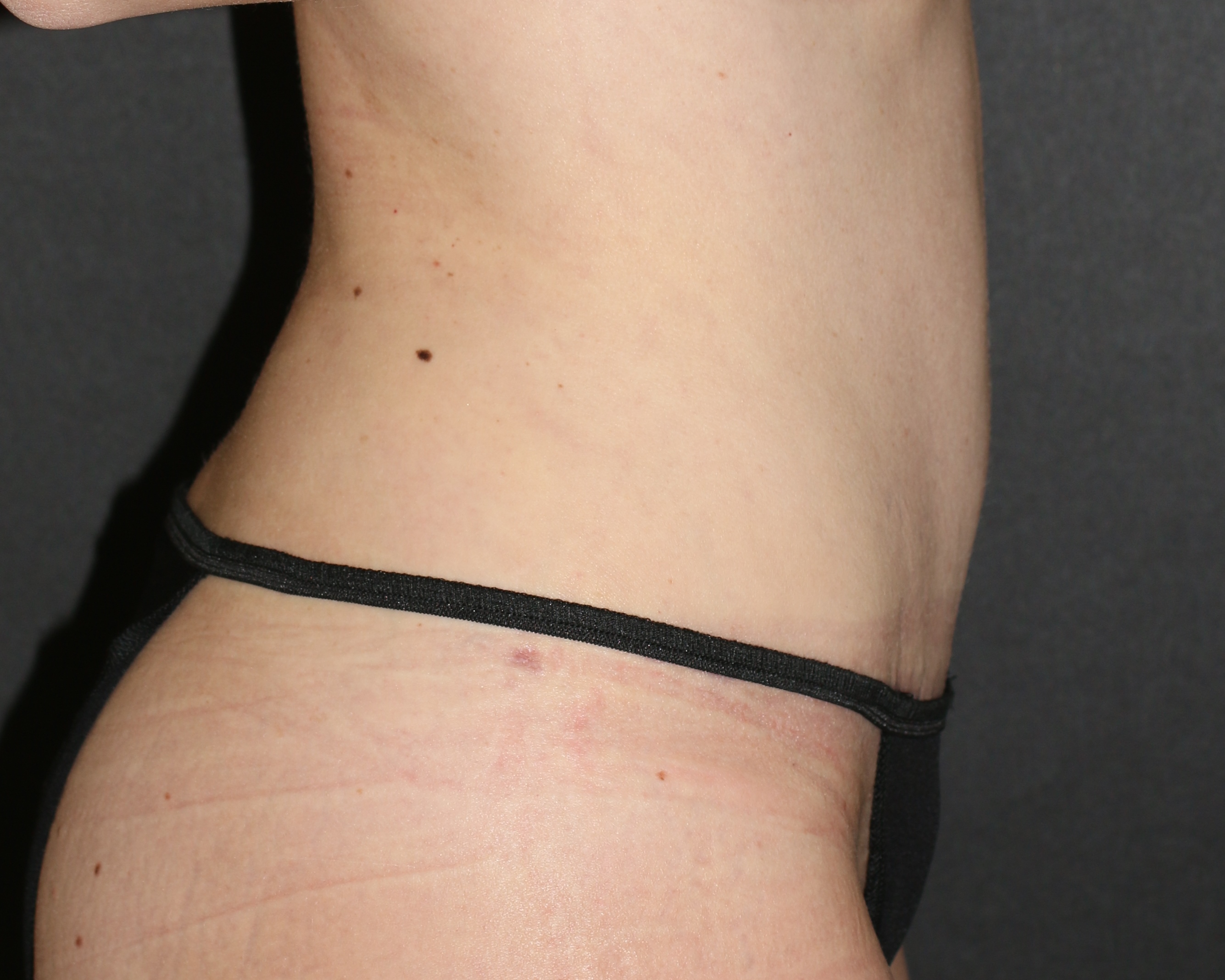 Tummy Tuck - Before & After - Dr. Placik