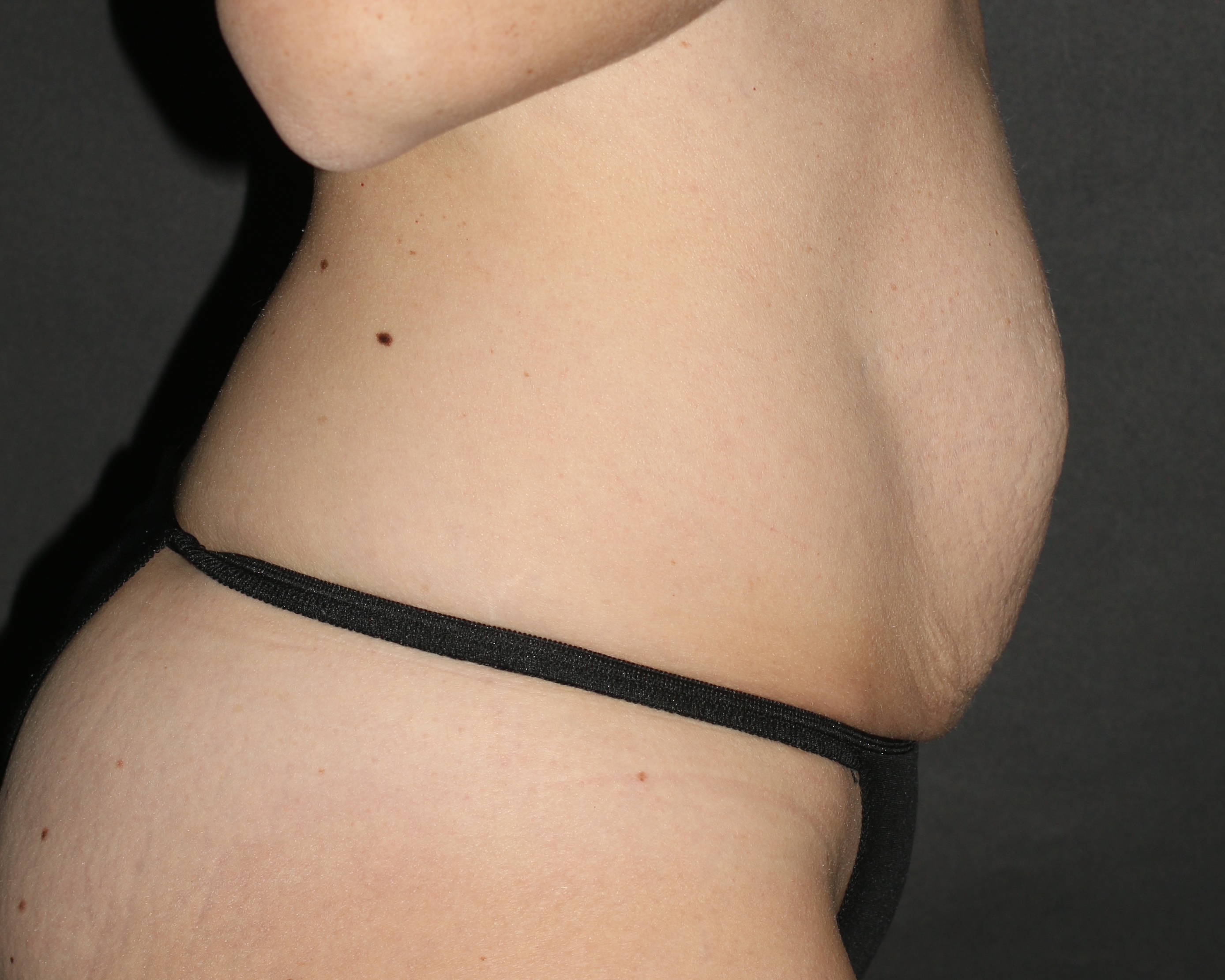 Tummy Tuck - Before & After - Dr. Placik