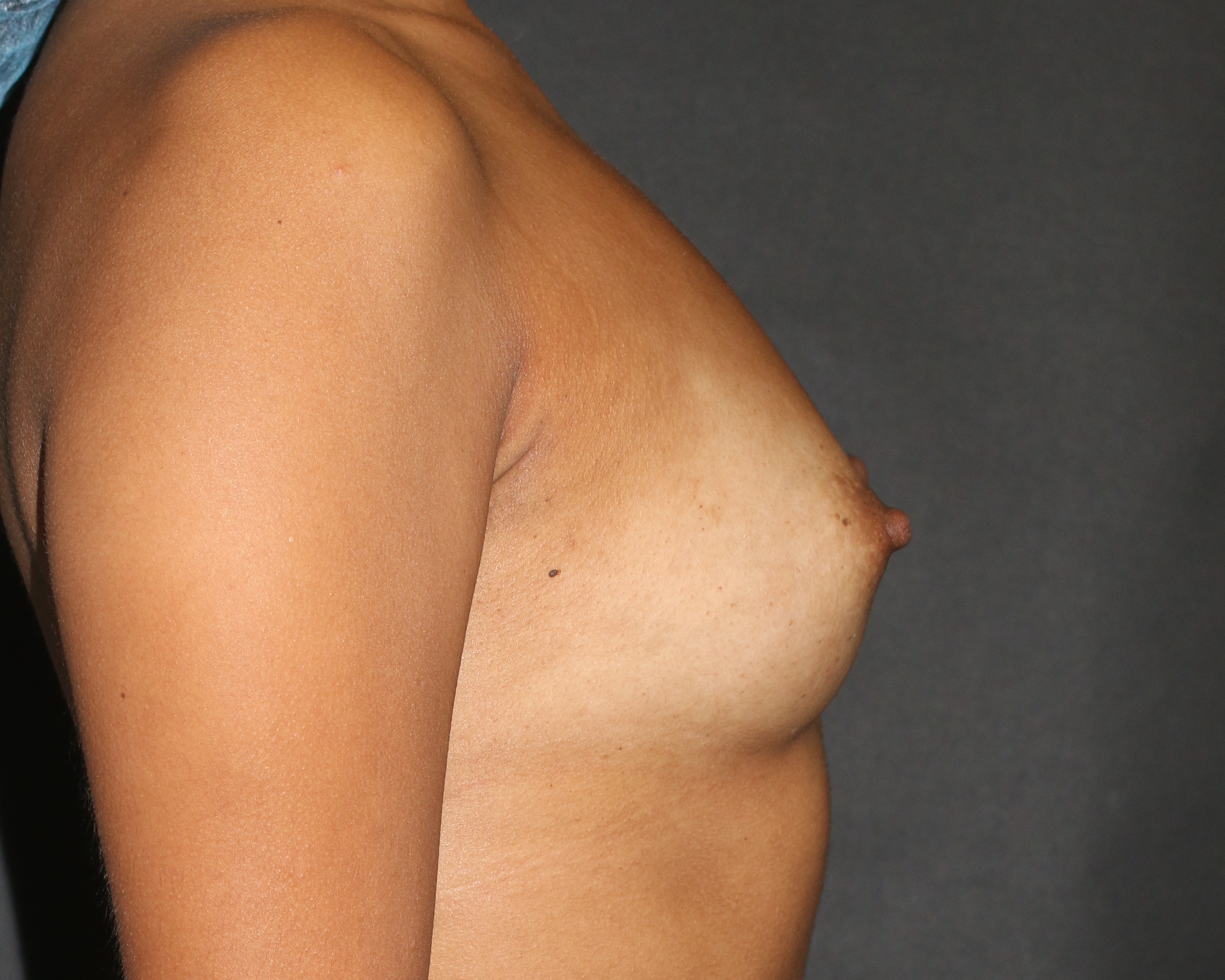 Breast Augmentation Chicago