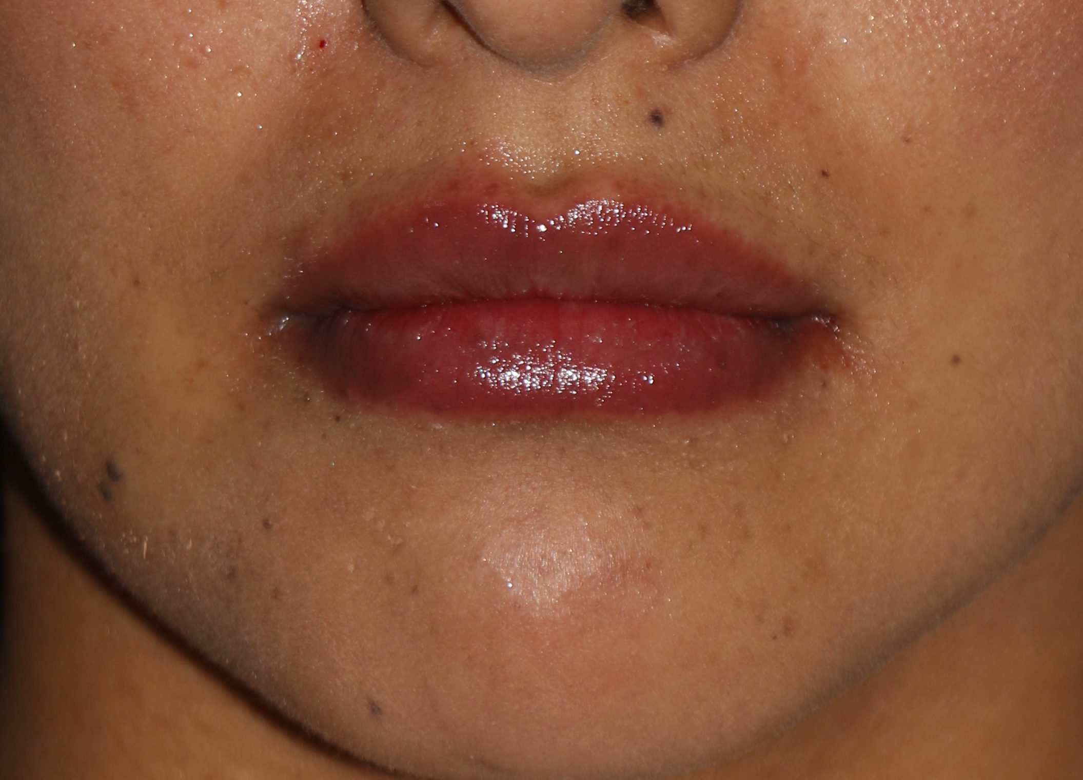 Lip Enhancement - Before & After - Dr. Placik