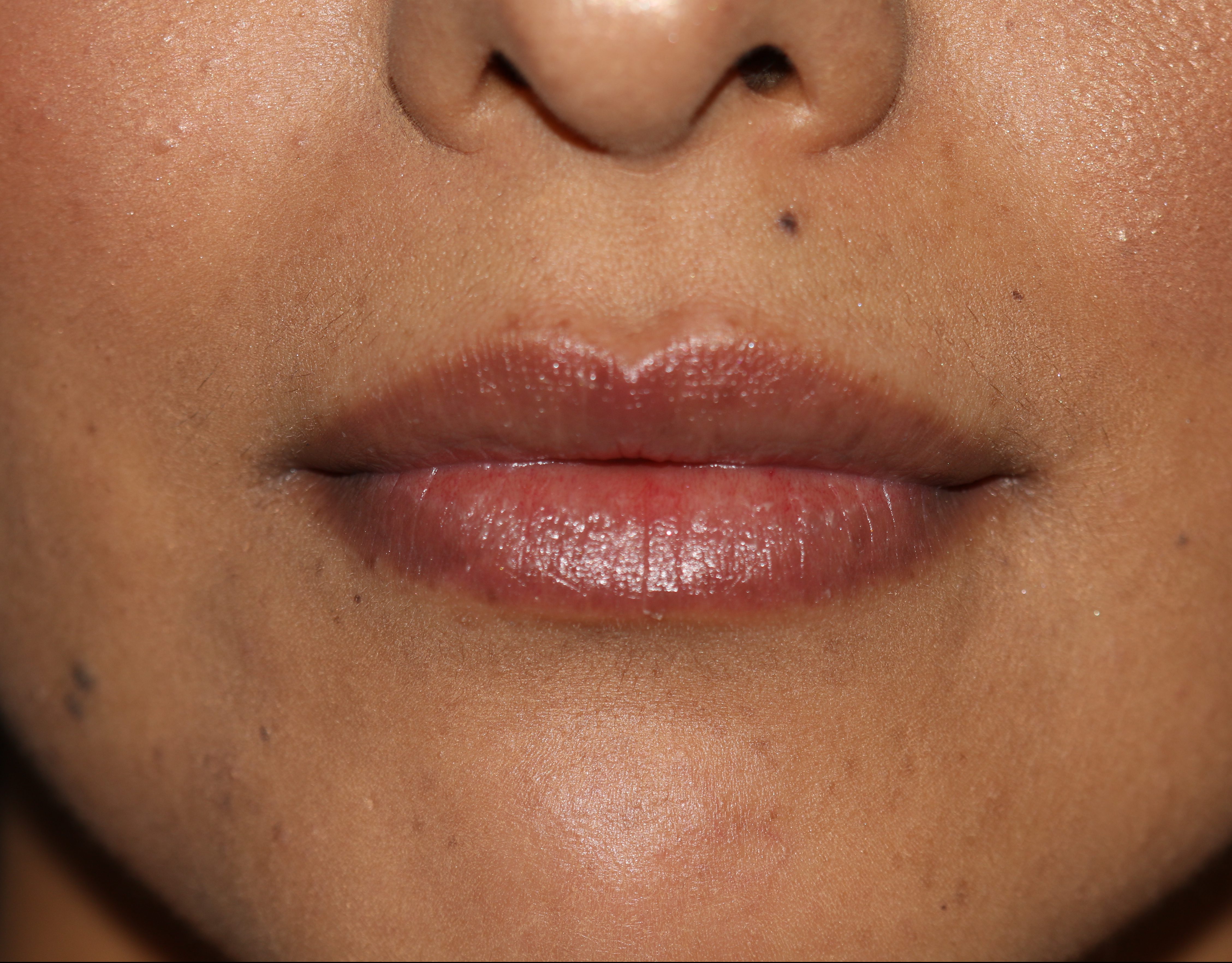 Lip Enhancement - Before & After - Dr. Placik