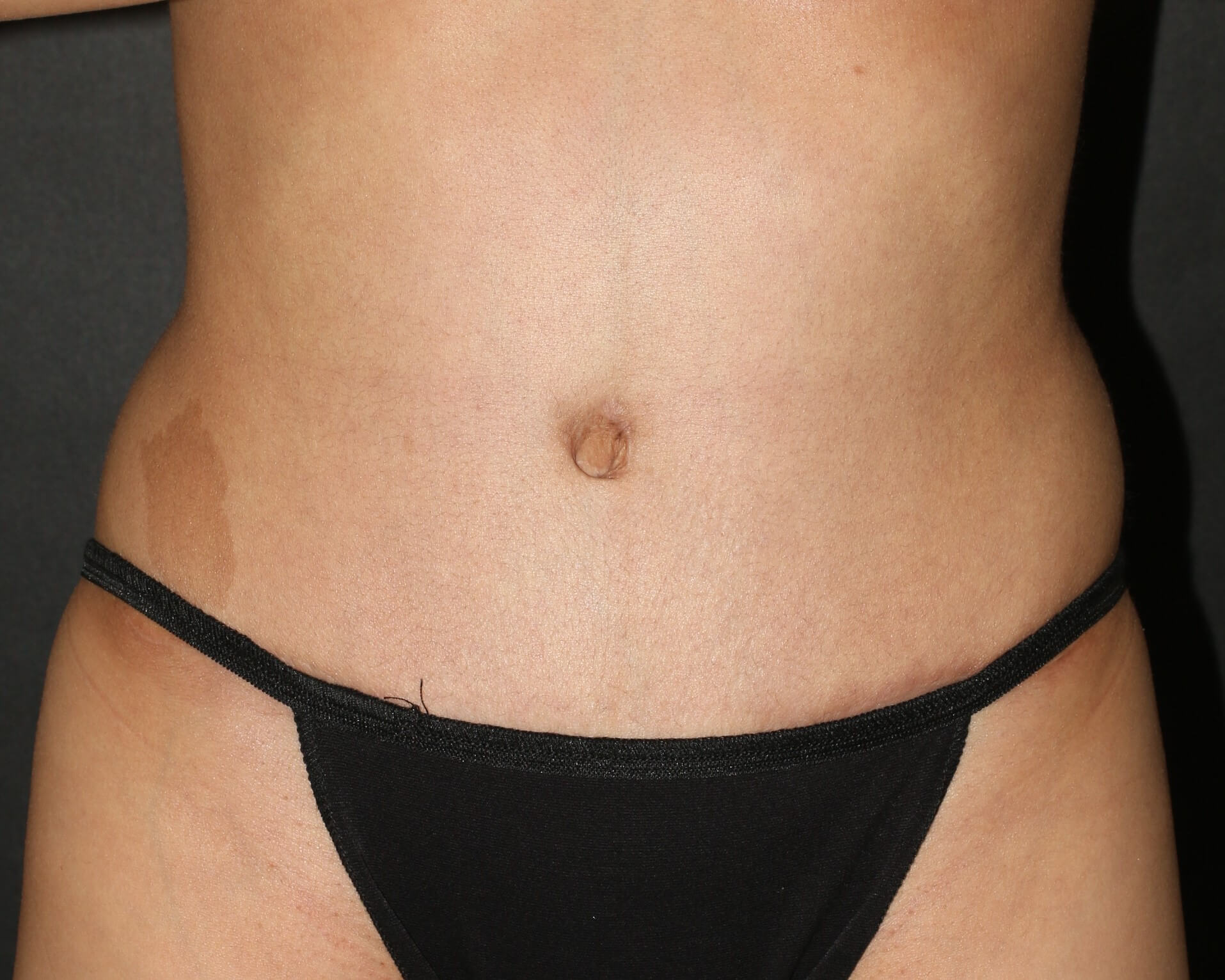 Tummy Tuck - Before & After - Dr. Placik