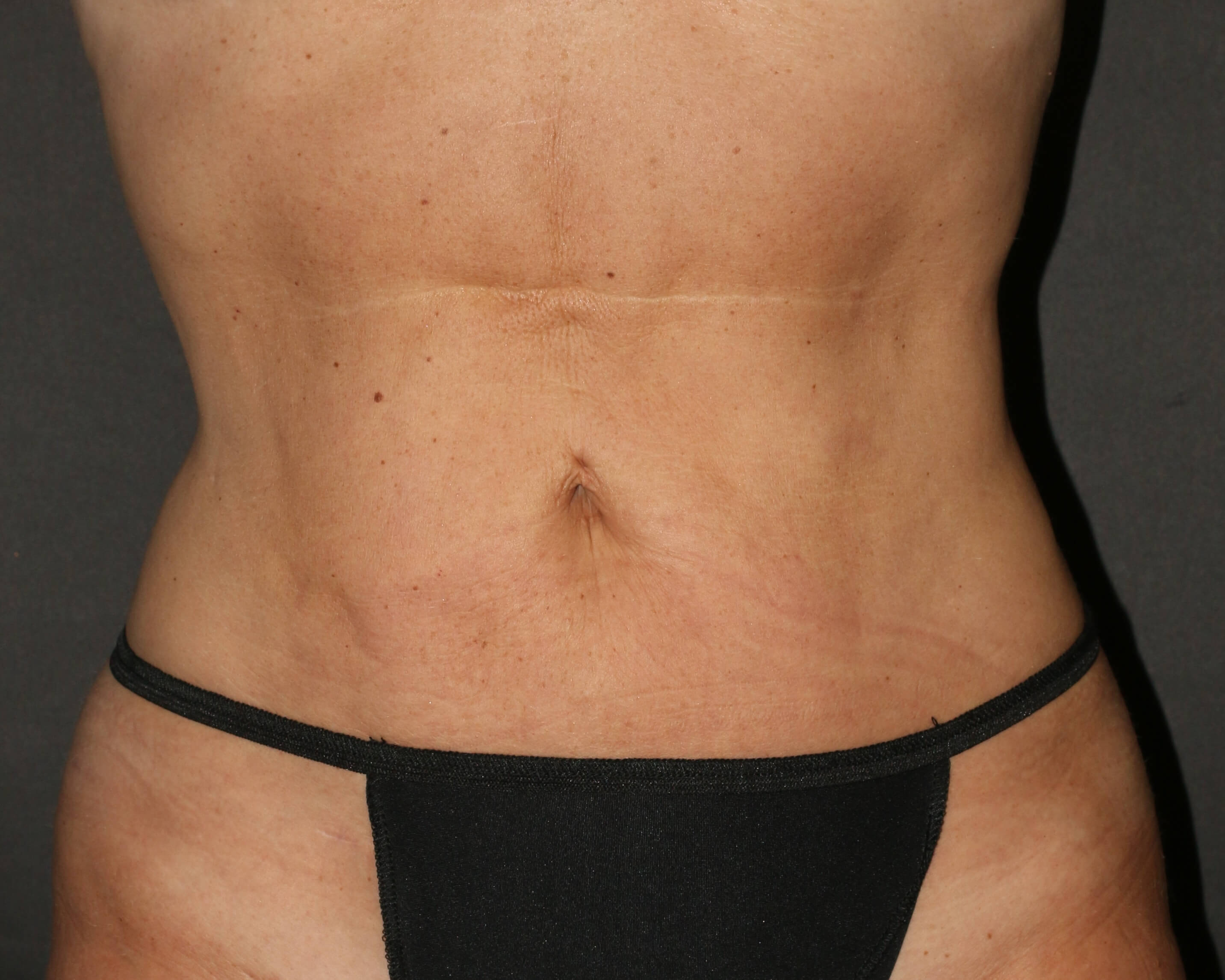 Liposuction - Before & After - Dr. Placik