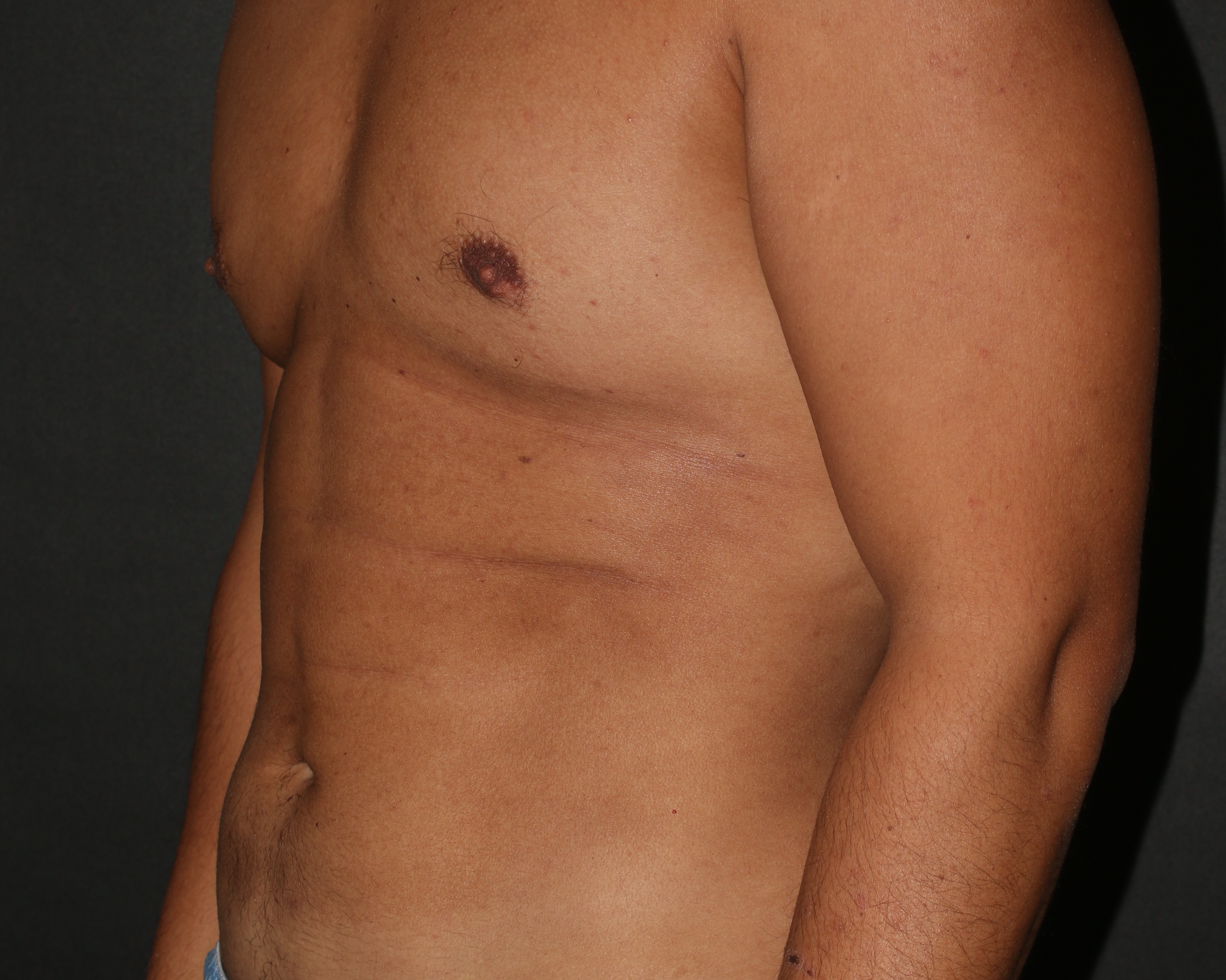 Male Liposuction - Before & After - Dr. Placik