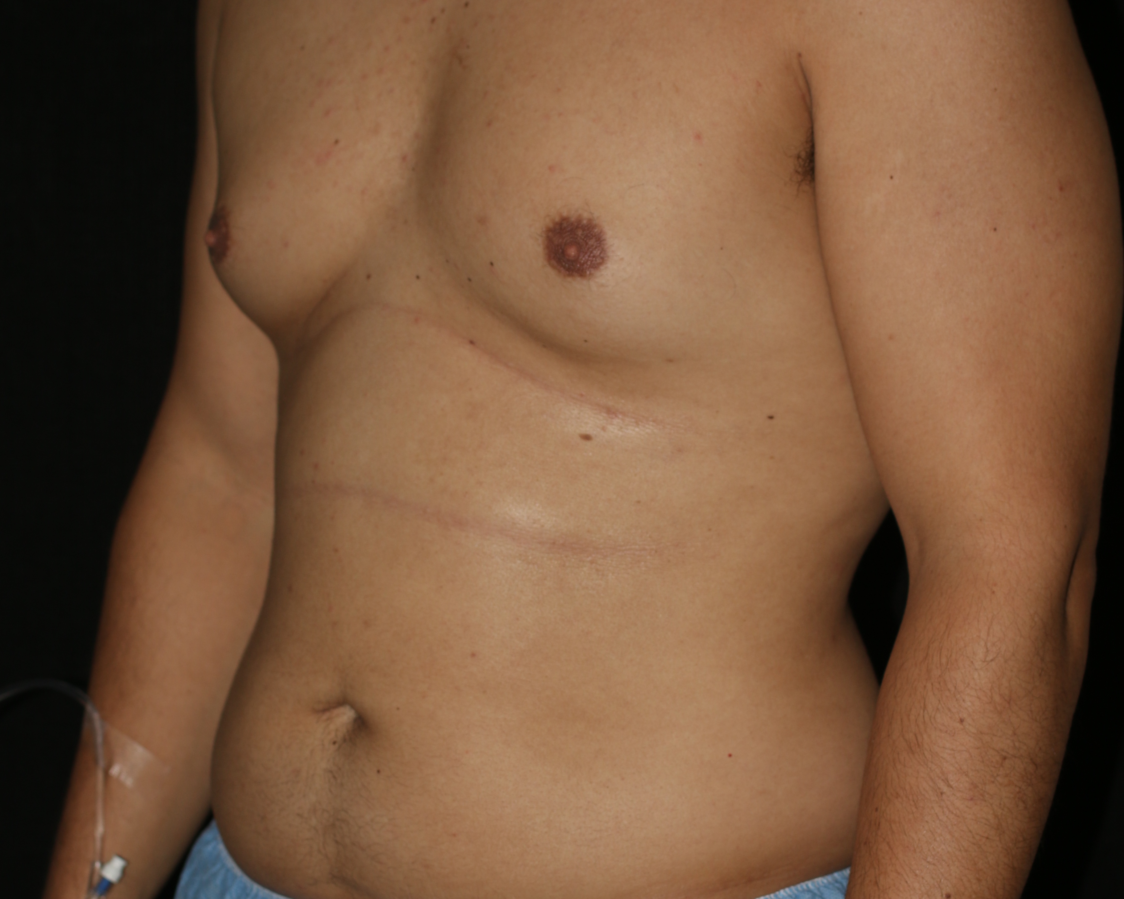 Male Liposuction - Before & After - Dr. Placik