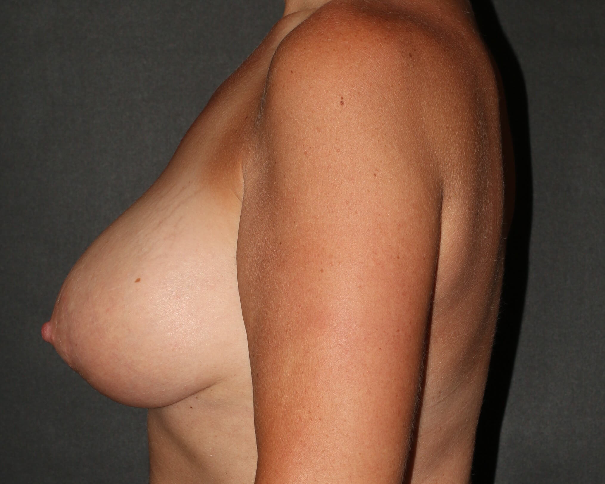 Breast Augmentation with Lift - Before & After - Dr. Placik