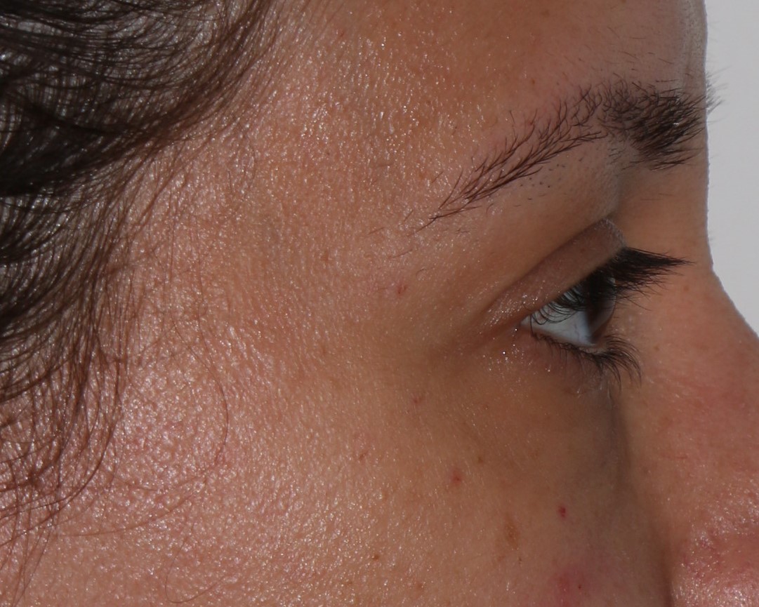 Injectable Filler Chicago