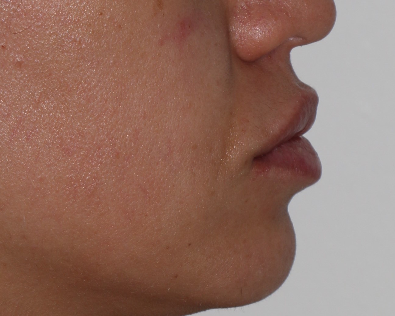 Injectable Filler Chicago