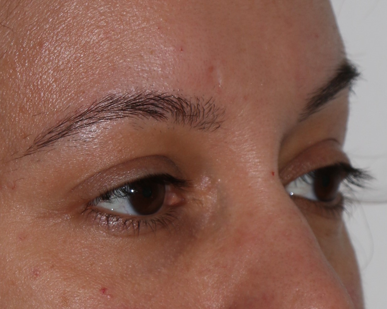 Injectable Filler Chicago