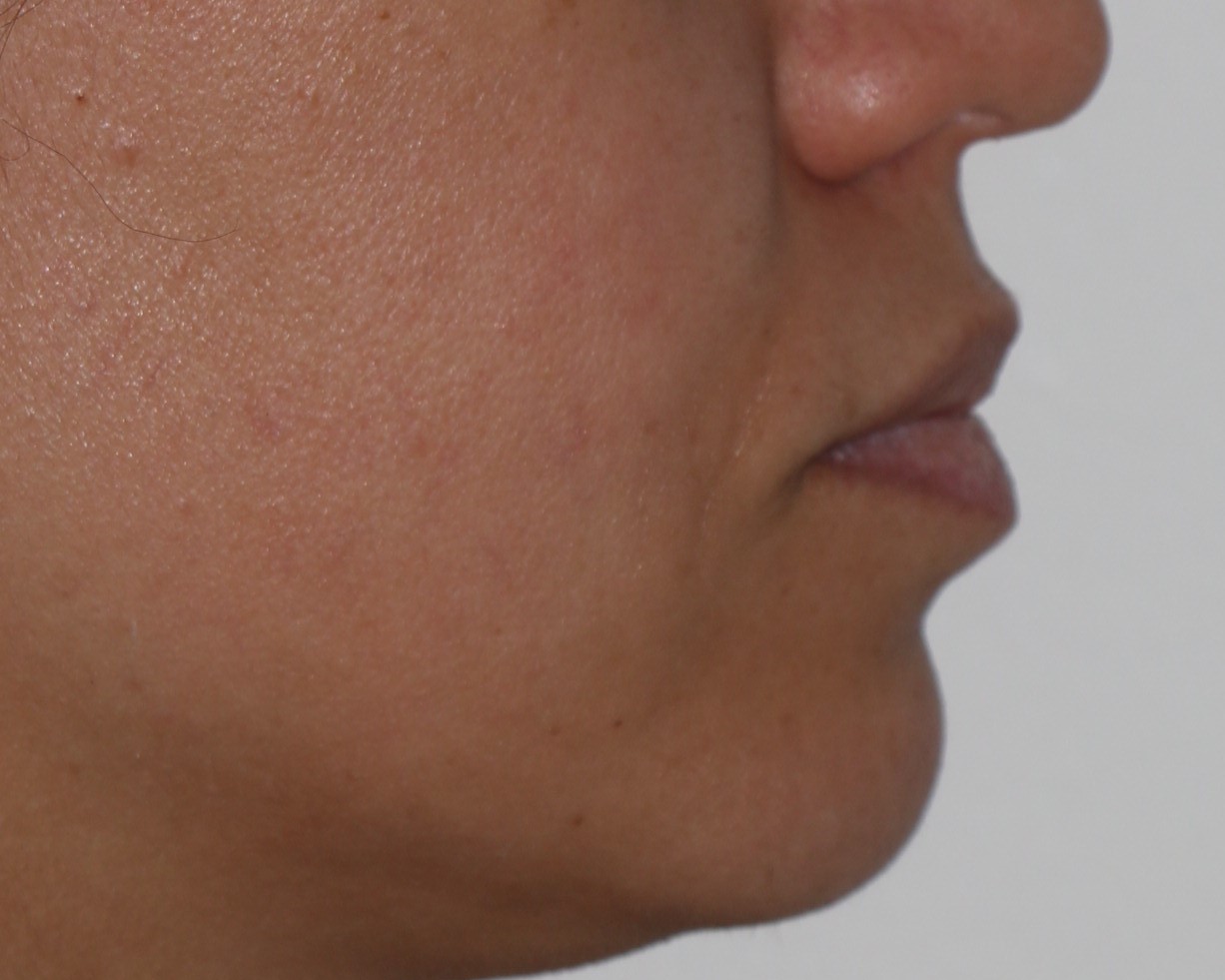 Injectable Filler Chicago