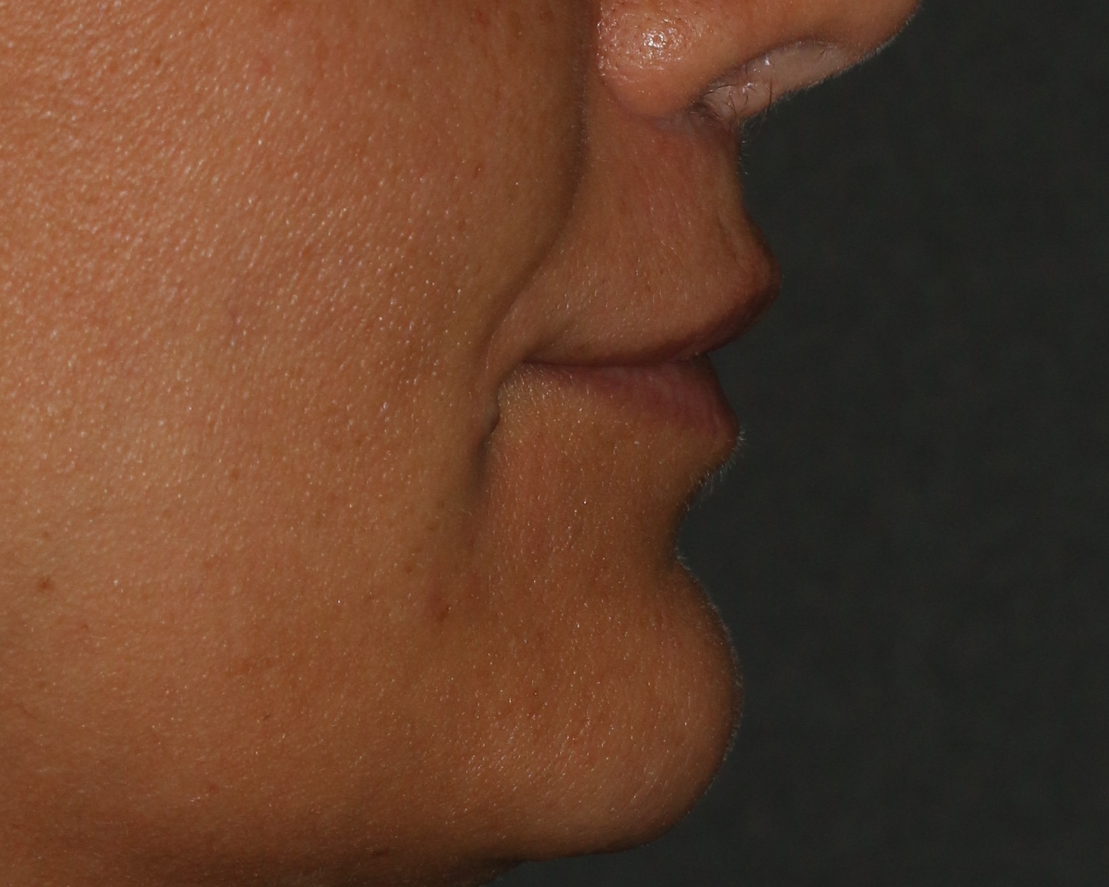 Lip Lift - Before & After - Dr. Placik