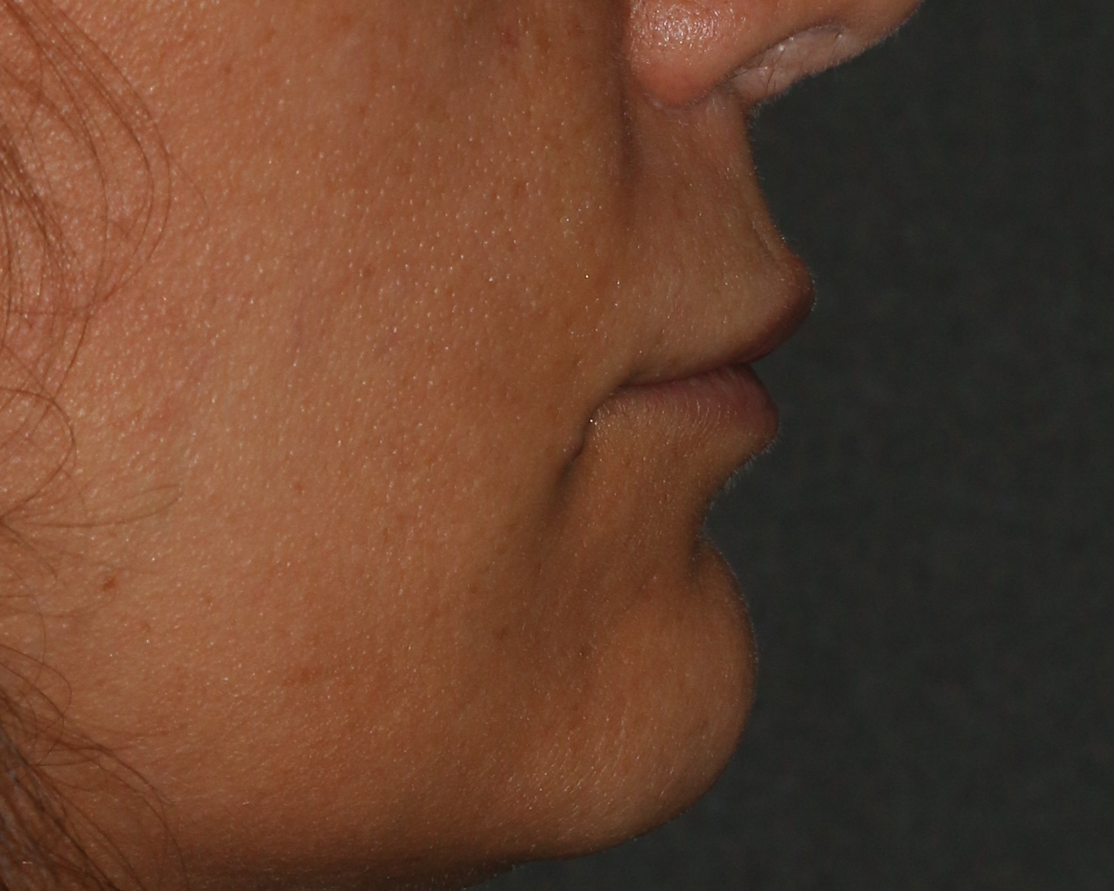 Lip Lift - Before & After - Dr. Placik