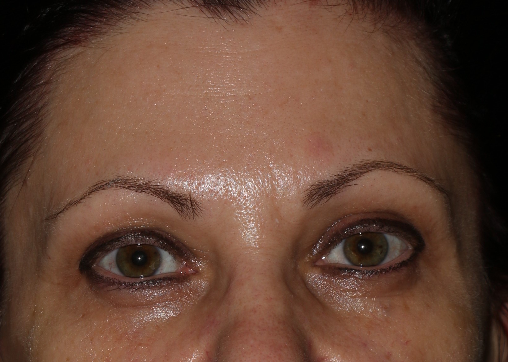 Injectable Filler - Before & After - Dr. Placik