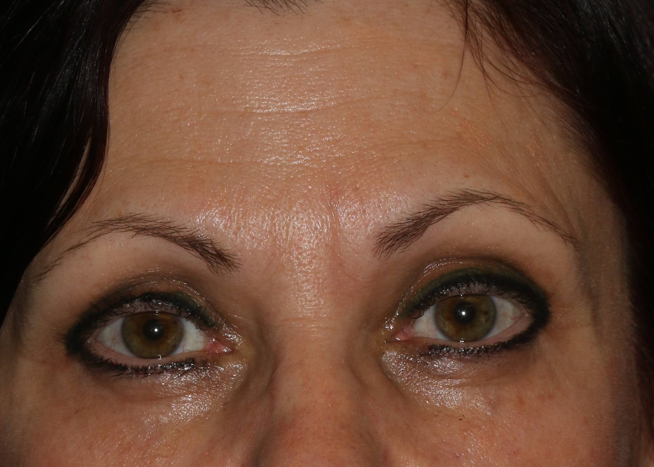 Injectable Filler - Before & After - Dr. Placik