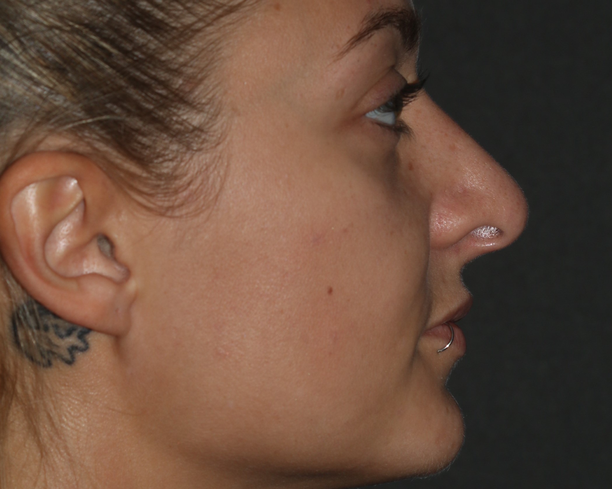 Rhinoplasty - Before & After - Dr. Placik