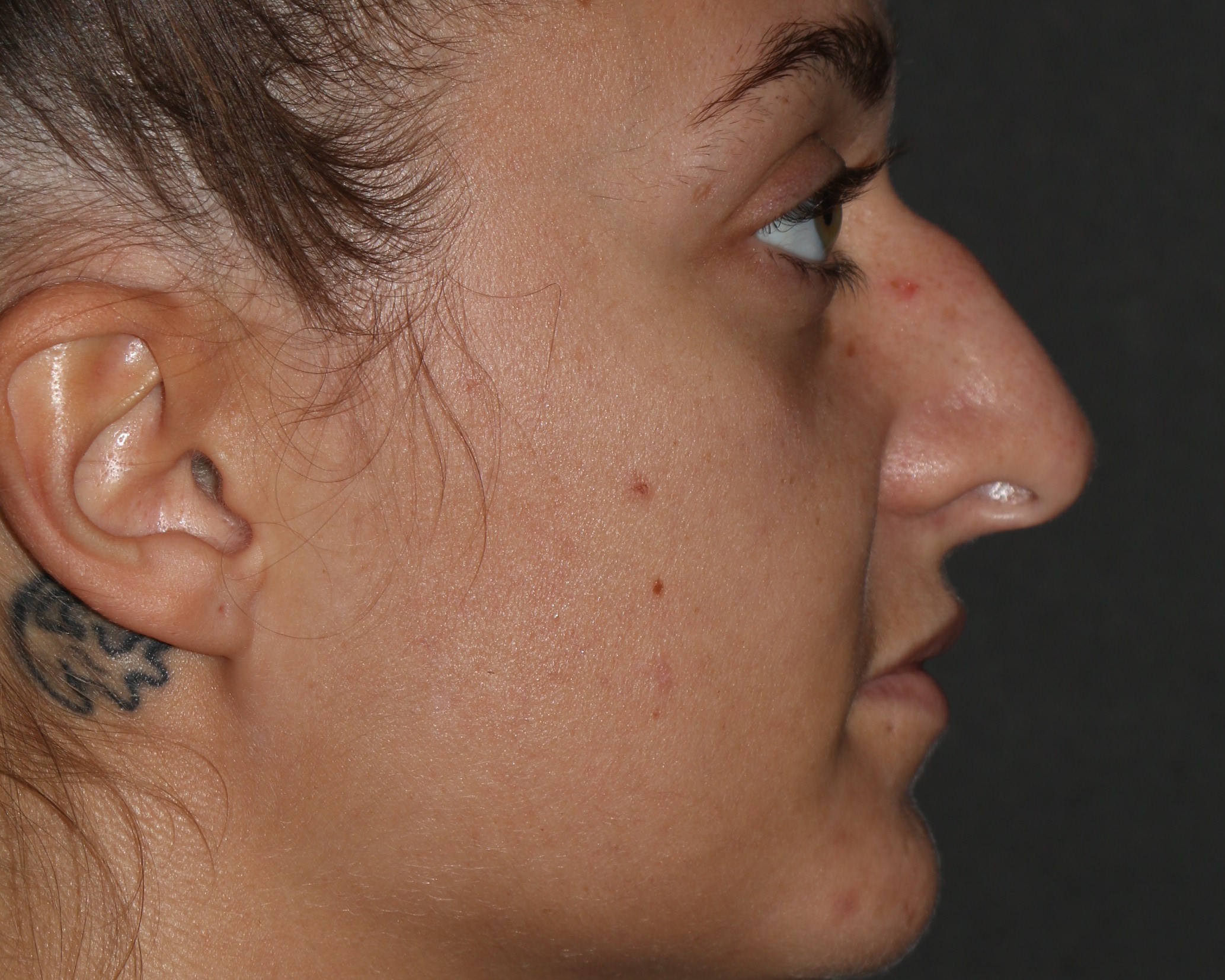 Rhinoplasty - Before & After - Dr. Placik