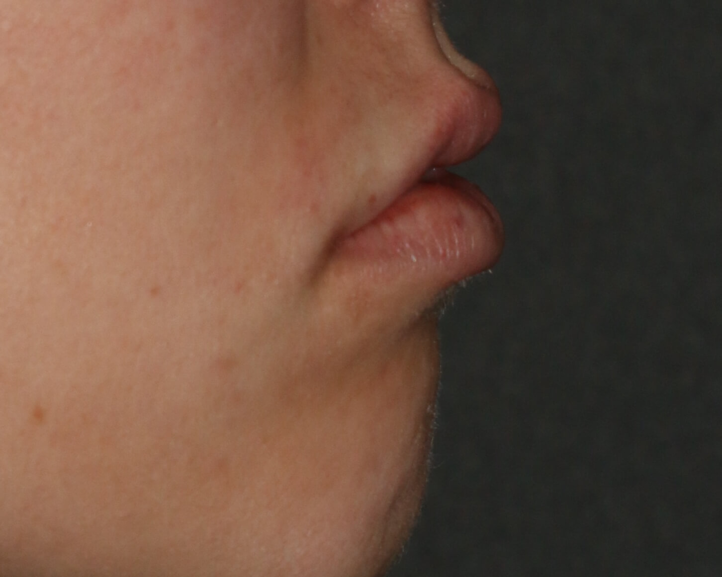 Lip Enhancement - Before & After - Dr. Placik