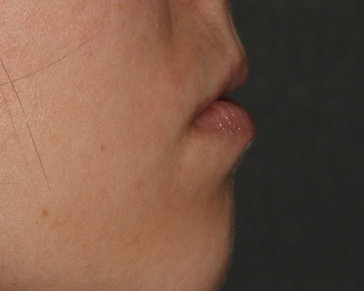 Lip Enhancement - Before & After - Dr. Placik