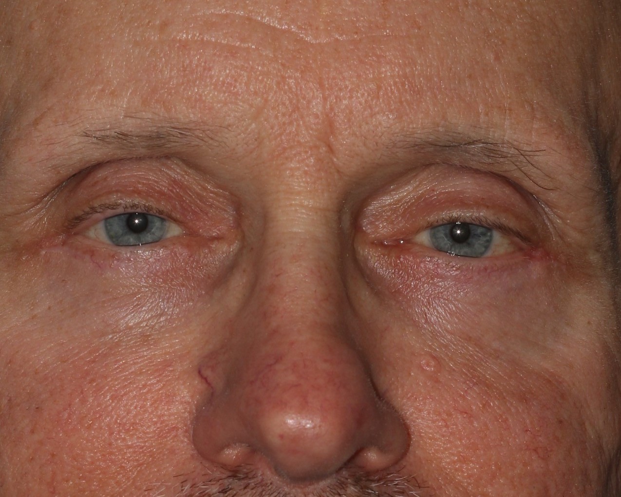 Eyelid Surgery - Before & After - Dr. Placik