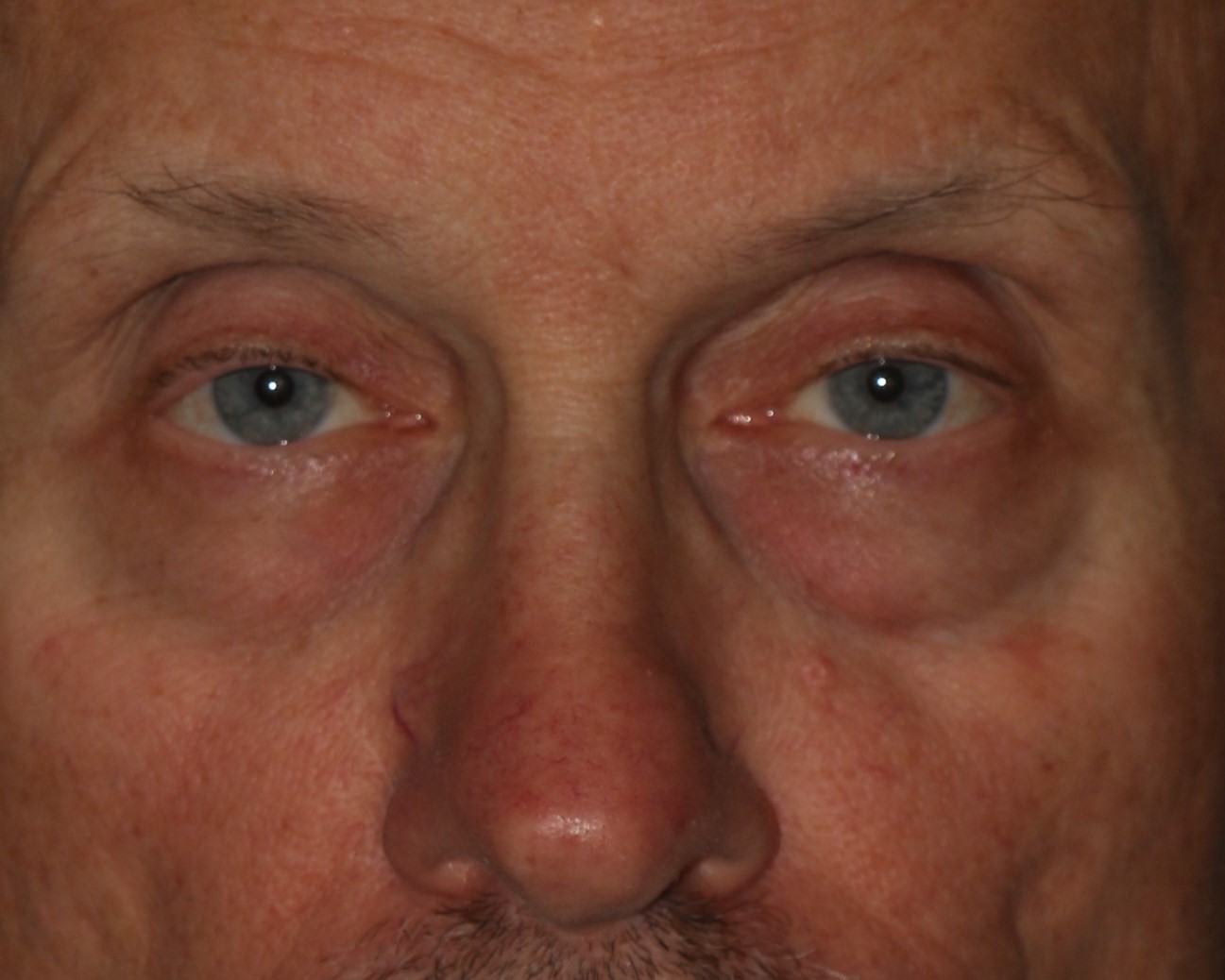 Eyelid Surgery - Before & After - Dr. Placik