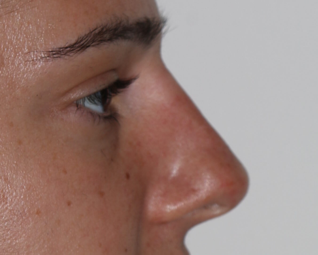 Non-Surgical Rhinoplasty - Before & After - Dr. Placik