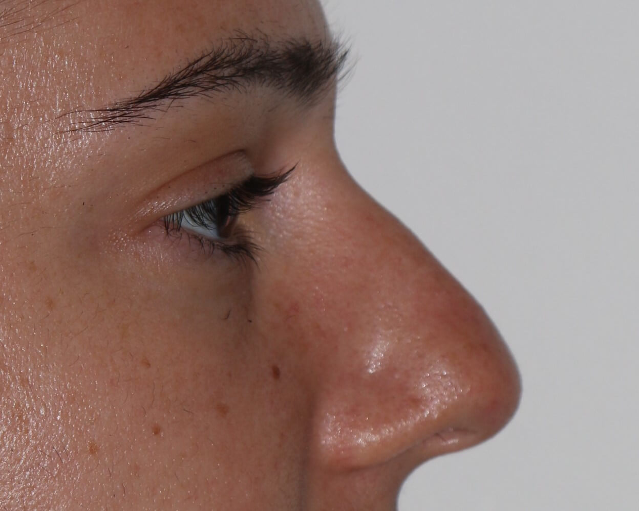 Non-Surgical Rhinoplasty - Before & After - Dr. Placik