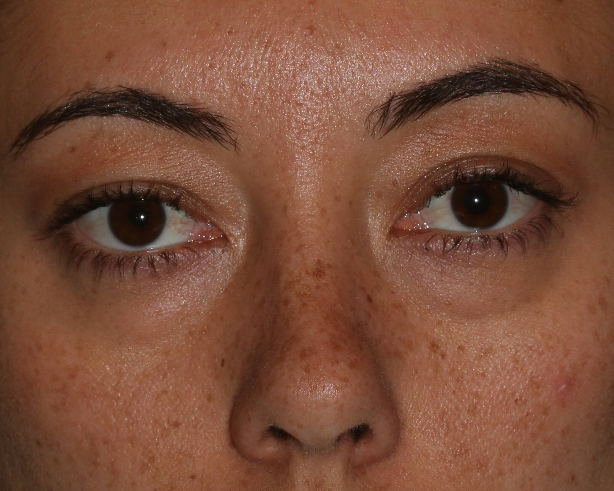 Injectable Filler - Before & After - Dr. Placik