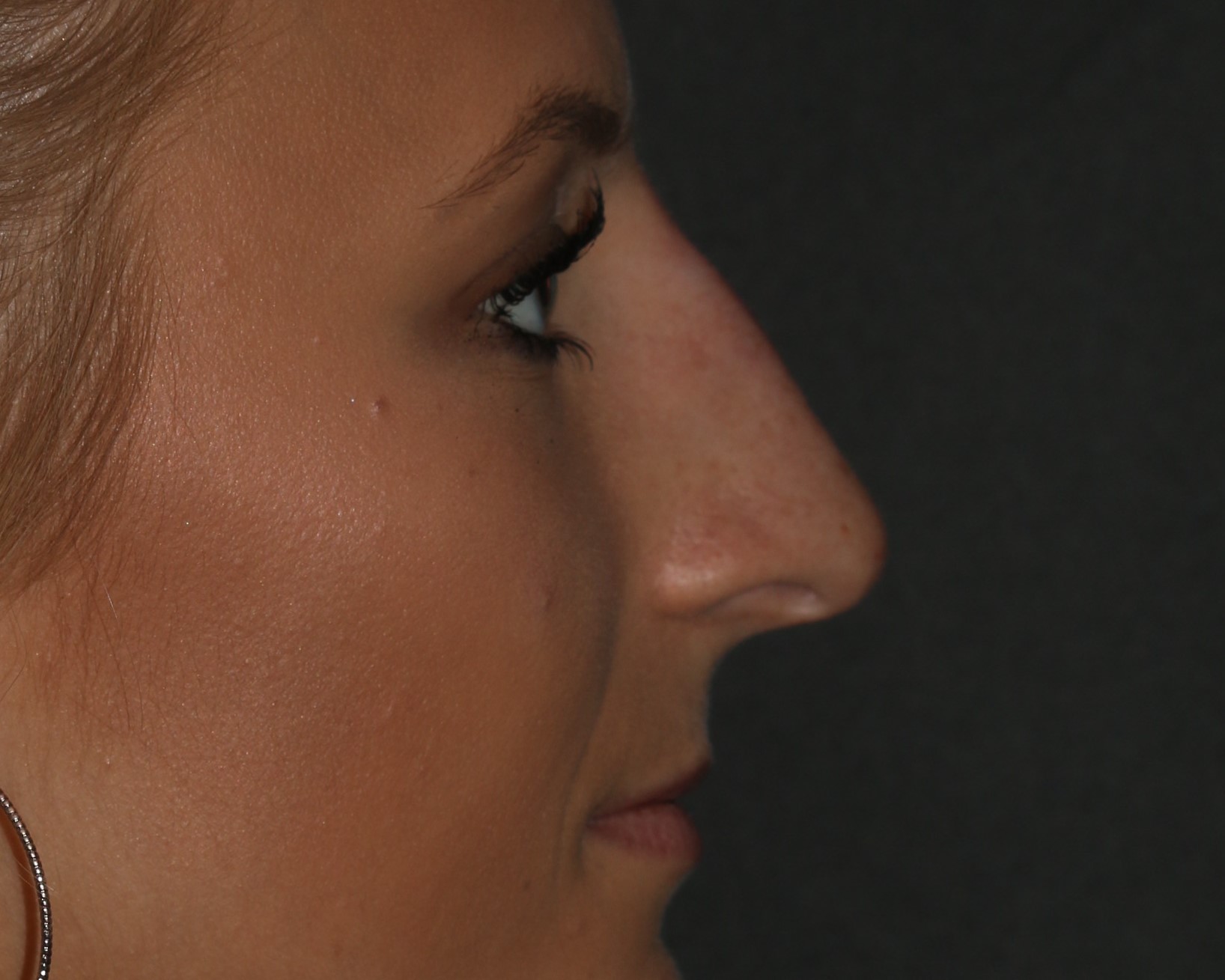 Non-Surgical Rhinoplasty - Before & After - Dr. Placik