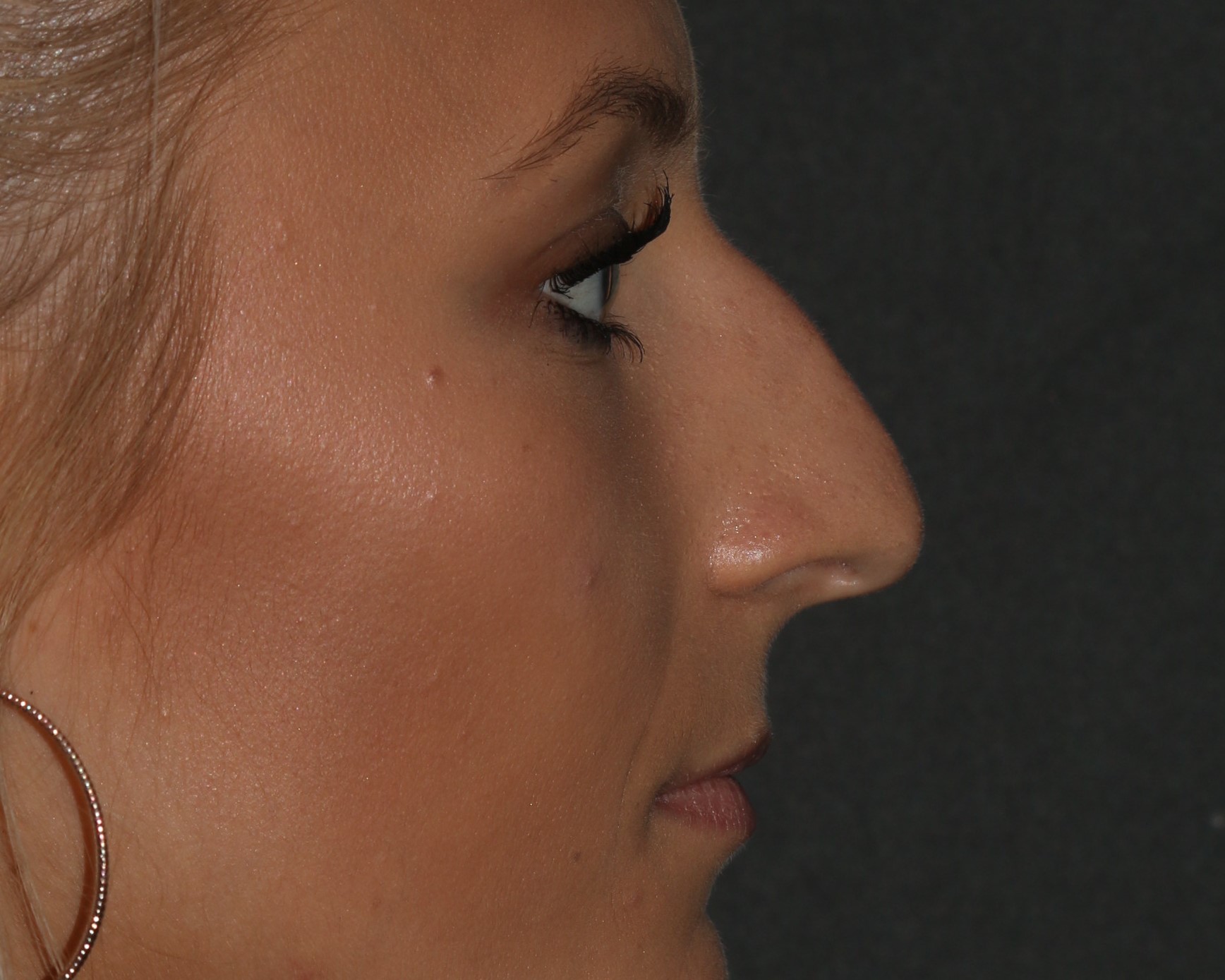 Non-Surgical Rhinoplasty - Before & After - Dr. Placik