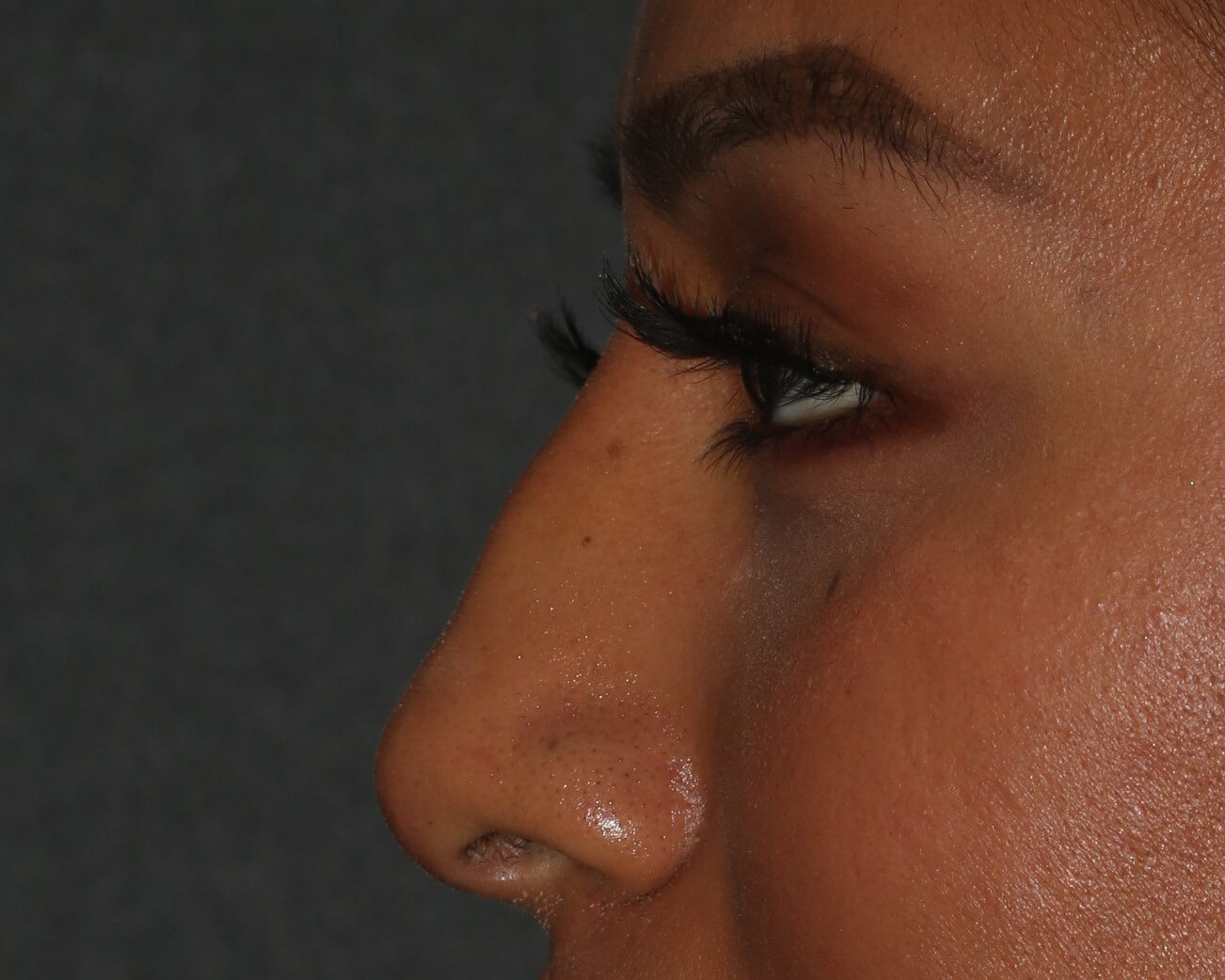 Non-Surgical Rhinoplasty - Before & After - Dr. Placik