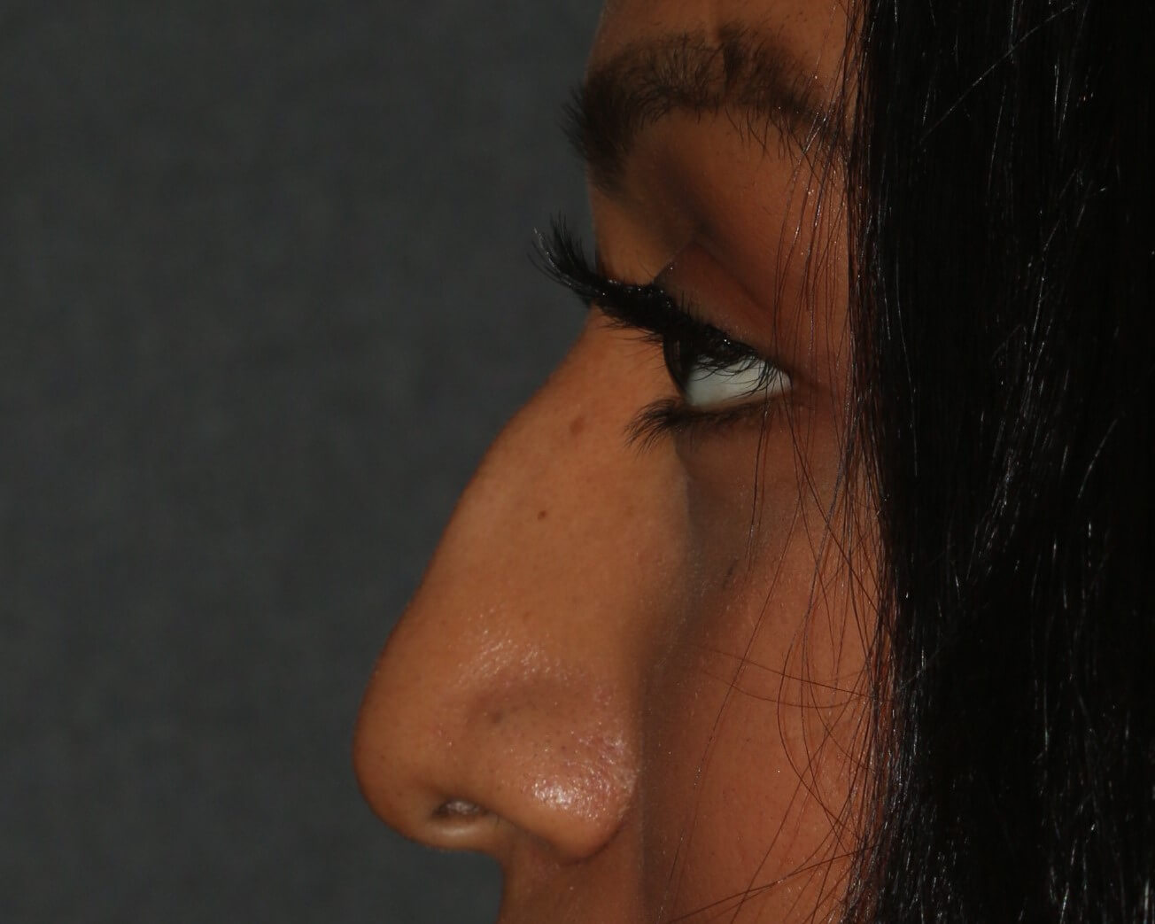 Non-Surgical Rhinoplasty - Before & After - Dr. Placik